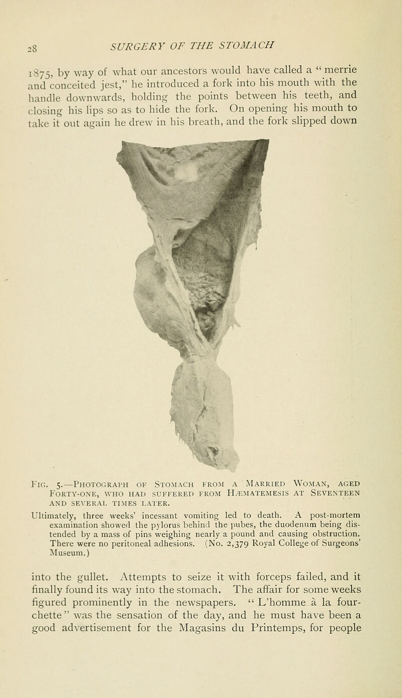 1875, by way of what our ancestors would have called a  merrie and conceited jest, he introduced a fork into his mouth with the handle downwards, holding the points between his teeth, and closing his lips so as to hide the fork. On opening his mouth to take it out again he drew in his breath, and the fork slipped down Y\Q. 5.—Photograph of Stomach from a Married Woman, aged Forty-one, who had suffered from H.-ematemesis at Seventeen AND several times LATER. Ultimately, three weeks' incessant vomiting led to death. A post-mortem examination showed the pylorus behind the jiubes, the duodenum being dis- tended by a mass of pins weighing nearly a pound and causing obstruction. There were no peritoneal adhesions. (No. 2,379 Royal College of Surgeons' Museum.) into the gullet. Attempts to seize it with forceps failed, and it finally found its way into the stomach. The affair for some weeks figured prominently in the newspapers.  L'homme a la four- chette  was the sensation of the day, and he must have been a good advertisement for the Magasins du Printemps, for people