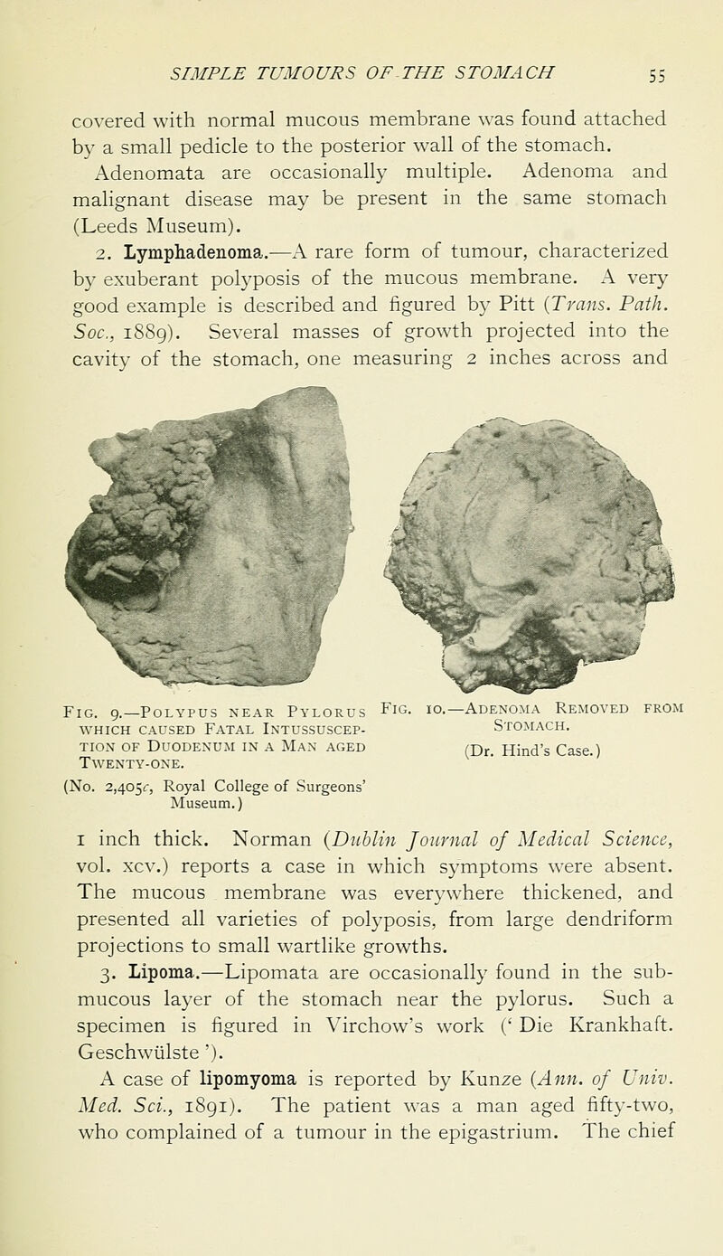 covered with normal mucous membrane was found attached by a small pedicle to the posterior w^all of the stomach. Adenomata are occasionally multiple. Adenoma and malignant disease may be present in the same stomach (Leeds Museum). 2. Lymphadenoma..—A rare form of tumour, characterized by exuberant polyposis of the mucous membrane. A very good example is described and figured b}' Pitt {Trans. Path. Soc, 1889). Several masses of growth projected into the cavity of the stomach, one measuring 2 inches across and Fig. 9.—Polypus near Pylorus Fig. 10.—Adenoma Removed from WHICH CAUSED FATAL InTUSSUSCEP- StOMACH. TION OF DUODEXUM IN A Man AGED rQj.^ Hind's Case.) Twenty-one. (No. 2,4051:, Royal College of Surgeons' Museum.) I inch thick. Norman (Dublin Journal of Medical Science, vol. xcv.) reports a case in which symptoms were absent. The mucous membrane was everywhere thickened, and presented all varieties of polyposis, from large dendriform projections to small wartlike growths. 3. Lipoma.—Lipomata are occasionally found in the sub- mucous layer of the stomach near the pylorus. Such a specimen is figured in \'irchow's work (' Die Krankhaft. Geschwiilste '). A case of lipomyoma is reported by Kunze {Ann. of Univ. Med. Sci., i8gi). The patient was a man aged fifty-two, who complained of a tumour in the epigastrium. The chief