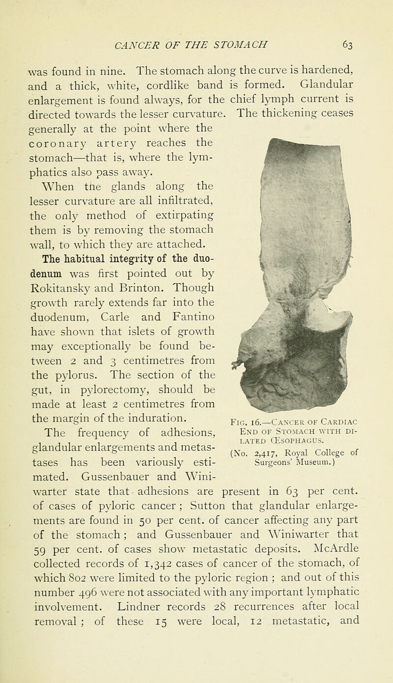 was found in nine. The stomach along the curve is hardened, and a thick, white, cordUke band is formed. Glandular enlargement is found always, for the chief lymph current is directed towards the lesser curvature. The thickening ceases generally at the point where the coronary artery reaches the stomach—that is, where the lym- phatics also pass away. When tne glands along the lesser curvature are all infiltrated, the only method of extirpating them is by removing the stomach wall, to which they are attached. The habitual integrity of the duo- denum was first pointed out by Rokitansky and Brinton. Though growth rarely extends far into the duodenum, Carle and Fantino have shown that islets of growth may exceptionally be found be- tween 2 and 3 centimetres from the pylorus. The section of the gut, in p3dorectomy, should be made at least 2 centimetres from the margin of the induration. The frequency of adhesions, glandular enlargements and metas- tases has been variously esti- mated. Gussenbauer and Wini- warter state that adhesions are present in 63 per cent. of cases of pyloric cancer ; Sutton that glandular enlarge- ments are found in 50 per cent, of cancer affecting any part of the stomach; and Gussenbauer and Winiwarter that 59 per cent, of cases show metastatic deposits. McArdle collected records of 1,342 cases of cancer of the stomach, of which 802 were limited to the pyloric region ; and out of this number 496 were not associated with any important lymphatic involvement. Lindner records 28 recurrences after local removal ; of these 15 were local, 12 metastatic, and Fig. 16.—Cancer of Cardiac End of Stomach with di- lated CESOPHAGUS. (Xo. 2,417, Royal College of Surgeons' Museum.)