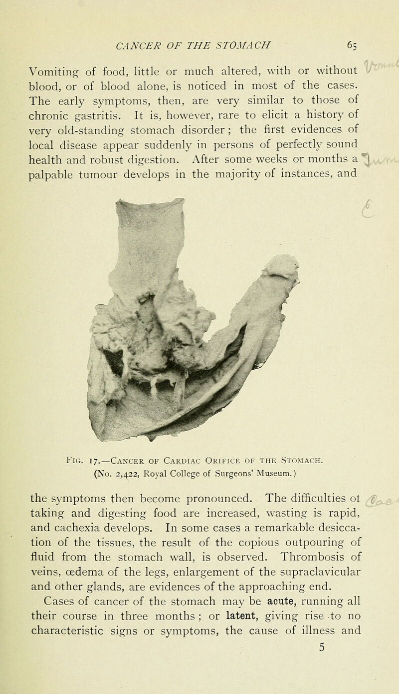 Vomiting of food, little or much altered, with or without blood, or of blood alone, is noticed in most of the cases. The early symptoms, then, are very similar to those of chronic gastritis. It is, however, rare to elicit a history of very old-standing stomach disorder ; the first evidences of local disease appear suddenly in persons of perfectly sound health and robust digestion. After some weeks or months a palpable tumour develops in the majority of instances, and £ Fig. 17.—Cancer of Cardiac Orifice of the Stomach. (No. 2,422, Royal College of Surgeons' Museum.) the symptoms then become pronounced. The difficulties ot taking and digesting food are increased, wasting is rapid, and cachexia develops. In some cases a remarkable desicca- tion of the tissues, the result of the copious outpouring of fluid from the stomach wall, is observed. Thrombosis of veins, oedema of the legs, enlargement of the supraclavicular and other glands, are evidences of the approaching end. Cases of cancer of the stomach may be acute, running all their course in three months ; or latent, giving rise to no characteristic signs or symptoms, the cause of illness and 5