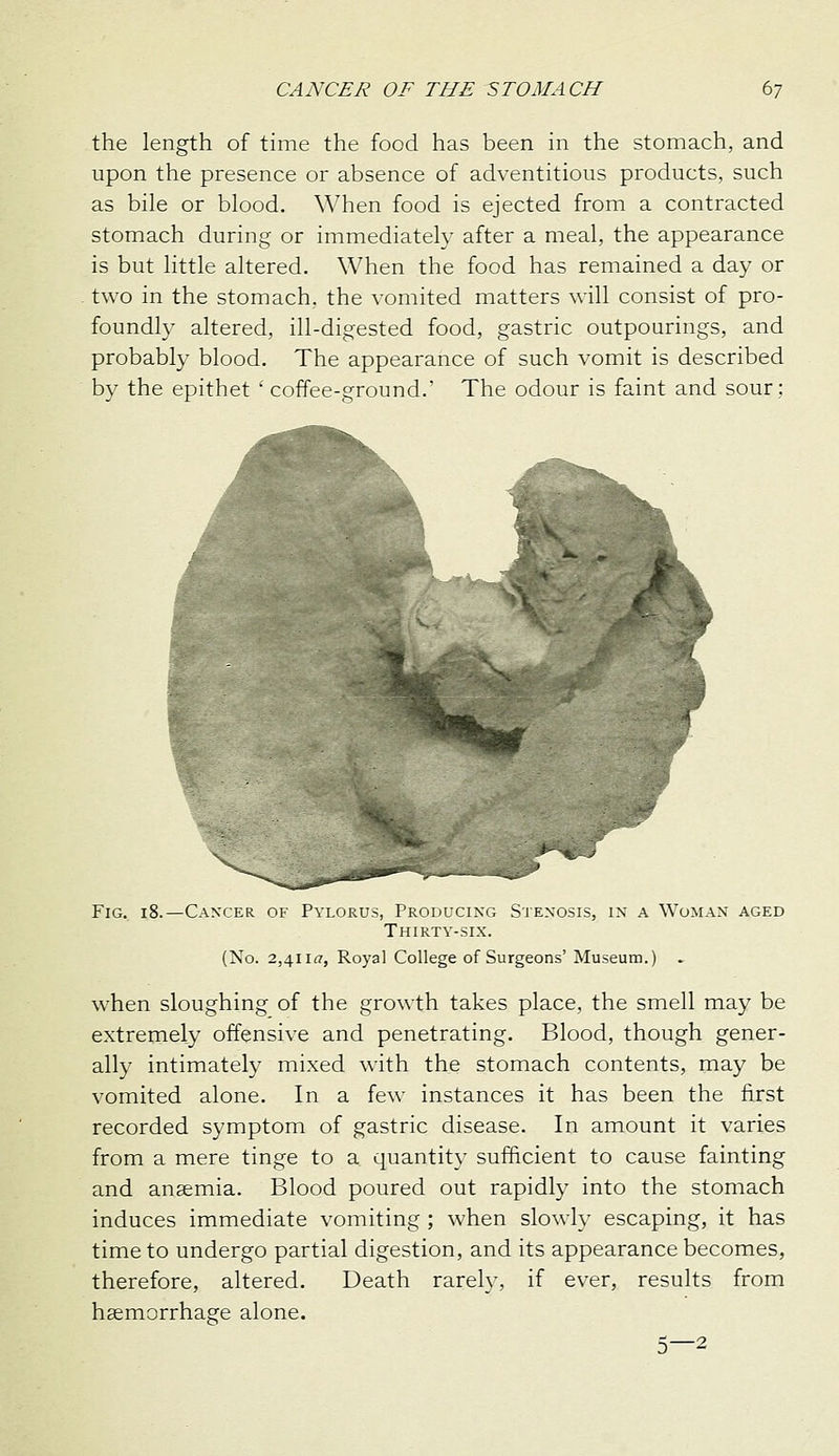 the length of time the food has been in the stomach, and upon the presence or absence of adventitious products, such as bile or blood, ^^^hen food is ejected from a contracted stomach during or immediately after a meal, the appearance is but little altered. When the food has remained a day or two in the stomach, the vomited matters will consist of pro- foundly altered, ill-digested food, gastric outpourings, and probably blood. The appearance of such vomit is described by the epithet ' coffee-ground.' The odour is faint and sour; Fig. 18.—Canxer of Pylorus, Producing Stenosis, in a Woman aged Thirty-six. (No. 2,4iifl', Royal College of Surgeons' Museum.) . when sloughing of the growth takes place, the smell may be extremely offensive and penetrating. Blood, though gener- ally intimately mixed with the stomach contents, may be vomited alone. In a few instances it has been the first recorded symptom of gastric disease. In amount it varies from a mere tinge to a quantity sufficient to cause fainting and anaemia. Blood poured out rapidly into the stomach induces immediate vomiting ; when slowly escaping, it has time to undergo partial digestion, and its appearance becomes, therefore, altered. Death rarely, if ever, results from hsemorrhage alone. 5—2