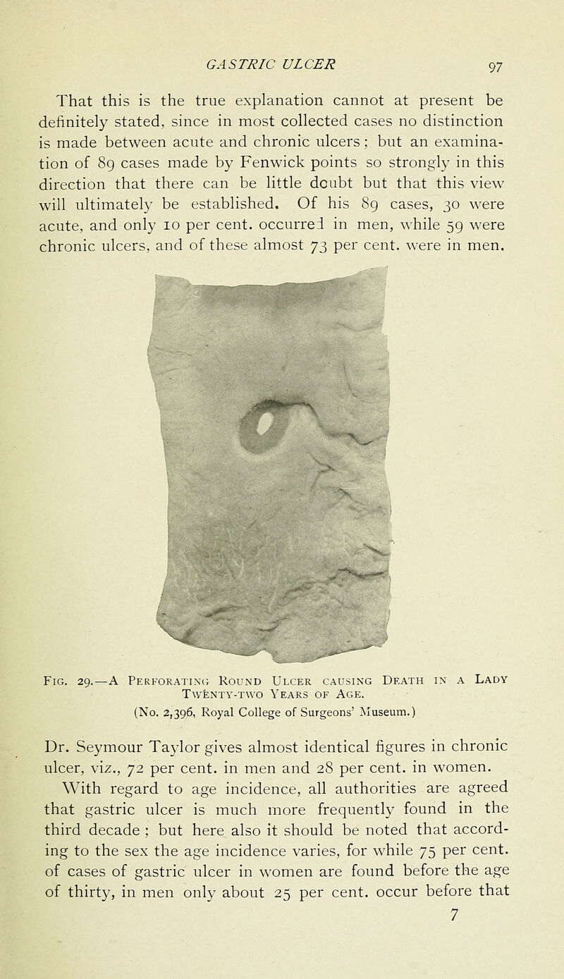 That this is the true explanation cannot at present be definitely stated, since in most collected cases no distinction is made between acute and chronic ulcers; but an examina- tion of 8g cases made by Fenwick points so strongly in this direction that there can be little doubt but that this view will ultimately be established. Of his 8g cases, 30 were acute, and only 10 per cent, occurrei in men, while 59 were chronic ulcers, and of these almost 73 per cent, were in men. Fig. 29.—A Perforating Round Ulcer causing Death in a Lady Twenty-two Years of Age. (No. 2,396, Royal College of Surgeons' Museum.) Dr. Seymour Taylor gives almost identical figures in chronic ulcer, viz., 72 per cent, in men and 28 per cent, in women. With regard to age incidence, all authorities are agreed that gastric ulcer is much more frequently found in the third decade ; but here also it should be noted that accord- ing to the sex the age incidence varies, for while 75 per cent, of cases of gastric ulcer in women are found before the age of thirty, in men only about 25 per cent, occur before that 7