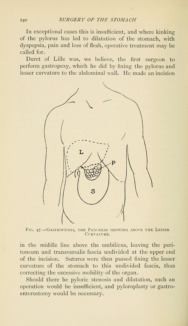 In exceptional cases this is insufficient, and where kinking of the pylorus has led to dilatation of the stomach, with dyspepsia, pain and loss of flesh, operative treatment may be called for. Duret of Lille was, we believe, the first surgeon to perform gastropexy, which he did by fixing the pylorus and lesser curvature to the abdominal wall. He made an incision Fig. 47.—Gastroptosis, the Pancreas showing above the Lesser Curvature. in the middle line above the umbilicus, leaving the peri- toneum and transversalis fascia undivided at the upper end of the incision. Sutures were then passed fixing the lesser curvature of the stomach to this undivided fascia, thus correcting the excessive mobility of the organ. Should there be pyloric stenosis and dilatation, such an operation would be insufficient, and pyloroplasty or gastro- enterostomy would be necessary.