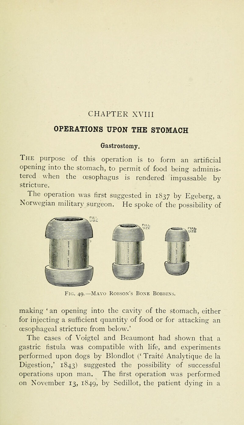CHAPTER XVni OPERATIONS UPON THE STOMACH Gastrostomy. The purpose of this operation is to form an artificial opening into the stomach, to permit of food being adminis- tered when the cesophagus is rendered impassable by stricture. The operation was first suggested in 1837 by Egeberg, a Norwegian military surgeon. He spoke of the possibility of Fig. 49.—Mayo Robson's Bone Bobbins. making ' an opening into the cavity of the stomach, either for injecting a sufficient quantity of food or for attacking an oesophageal stricture from below.' The cases of Voigtel and Beaumont had shown that a gastric fistula was compatible with life, and experiments performed upon dogs by Blondlot (' Traite Analytique de la Digestion,' 1843) suggested the possibility of successful operations upon man. The first operation was performed
