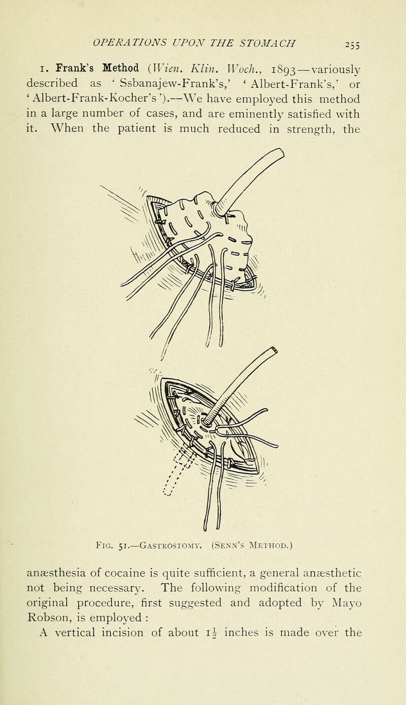 I. Frank's Method {^Wien, Klin. Woch., 1893—variously described as ' Ssbanajew-Frank's,' ' Albert-Frank's,' or 'i\.lbert-Frank-Kocher's').—We have employed this method in a large number of cases, and are eminently satisfied with it. When the patient is much reduced in strength, the Fig. 51.—Gastrostomy. (Senn's ^Method. anaesthesia of cocaine is quite sufficient, a general anaesthetic not being necessary. The following modification of the original procedure, first suggested and adopted by Mayo Robson, is employed : A vertical incision of about ih inches is made over the