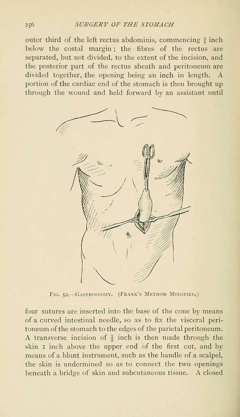 outer third of the left rectus abdominis, commencing f inch below the costal margin ; the fibres of the rectus are separated, but not divided, to the extent of the incision, and the posterior part of the rectus sheath and peritoneum are di^•ided together, the opening being an inch in length. A portion of the cardiac end of the stomach is then brought up through the wound and held forward by an assistant until Fig. 52.—Gastrostomy. (Frank's Method Modified.) four sutures are inserted into the base of the cone by means of a curved intestinal needle, so as to fix the visceral peri- toneum of the stomach to the edges of the parietal peritoneum. A transverse incision of | inch is then made through the skin I inch above the upper end of the first cut, and by means of a blunt instrument, such as the handle of a scalpel, the skin is undermined so as to connect the two openings beneath a bridg^e of skin and subcutaneous tissue. A closed