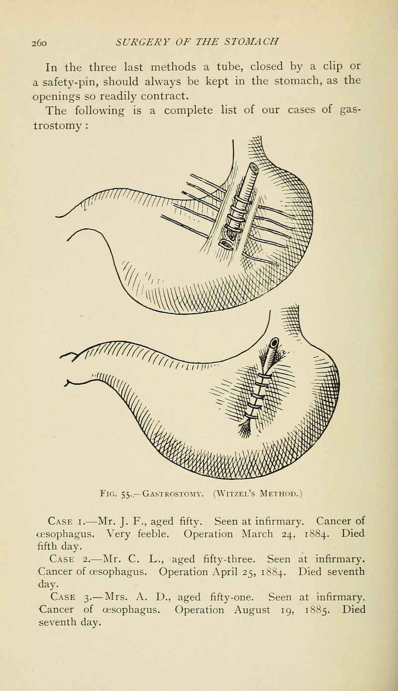 In the three last methods a tube, closed by a clip or a safety-pin, should always be kept in the stomach, as the openings so readily contract. The following is a complete list of our cases of gas- trostomy : Fig. 55..—Gastrostomy. (Witzel's Method.) Case i.—Mr. J. F., aged fifty. Seen at infirmary. Cancer of oesophagus. Very feeble. Operation March 24, 1884. Died fifth day. Case 2.—Mr. C. L., aged fifty-three. Seen at infirmary. Cancer of oesophagus. Operation April 25, 18S4. Died seventh day. Case 3.—Mrs. A. D., aged fifty-one. Seen at infirmary. Cancer of oesophagus. Operation August ig, 1885. Died seventh day.