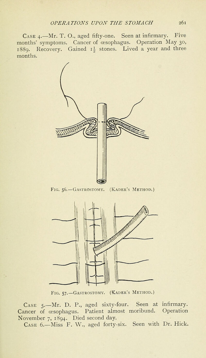 Case 4.—Mr. T. O., aged fifty-one. Seen at infirmary. Five months' symptoms. Cancer of cesophagus. Operation May 30, i88g. Recovery. Gained ih stones. Lived a year and three months. Fig. 56.—Gastrostomy. (Kader's Method.) Fig. 57.—Gastrostomy. (Kader's Method.) Case 5.—Mr. D. P., aged sixty-four. Seen at infirmary. Cancer of oesophagus. Patient almost moribund. Operation November 7, 1894. Died second day. Case 6.—Miss F. W., aged forty-six. Seen with Dr. Hick.