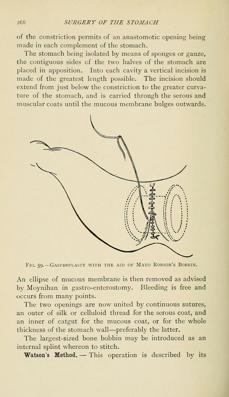 of the constriction permits of an anastomotic opening being made in each complement of the stomach. The stomach being isolated by means of sponges or gauze, the contiguous sides of the two halves of the stomach are placed in apposition. Into each cavity a vertical incision is made of the greatest length possible. The incision should extend from just below the constriction to the greater curva- ture of the stomach, and is carried through the serous and muscular coats until the mucous membrane bulges outwards. Fig. 59.—Gastroplasty with the aid of Mayo Robson's Bobbin. An ellipse of mucous membrane is then removed as advised by Moynihan in gastro-enterostomy. Bleeding is free and occurs from many points. The two openings are now united by continuous sutures, an outer of silk or celluloid thread for the serous coat, and an inner of catgut for the mucous coat, or for the whole thickness of the stomach wall—preferably the latter. The largest-sized bone bobbin may be introduced as an internal splint whereon to stitch. Watsons Method. — This operation is described by its