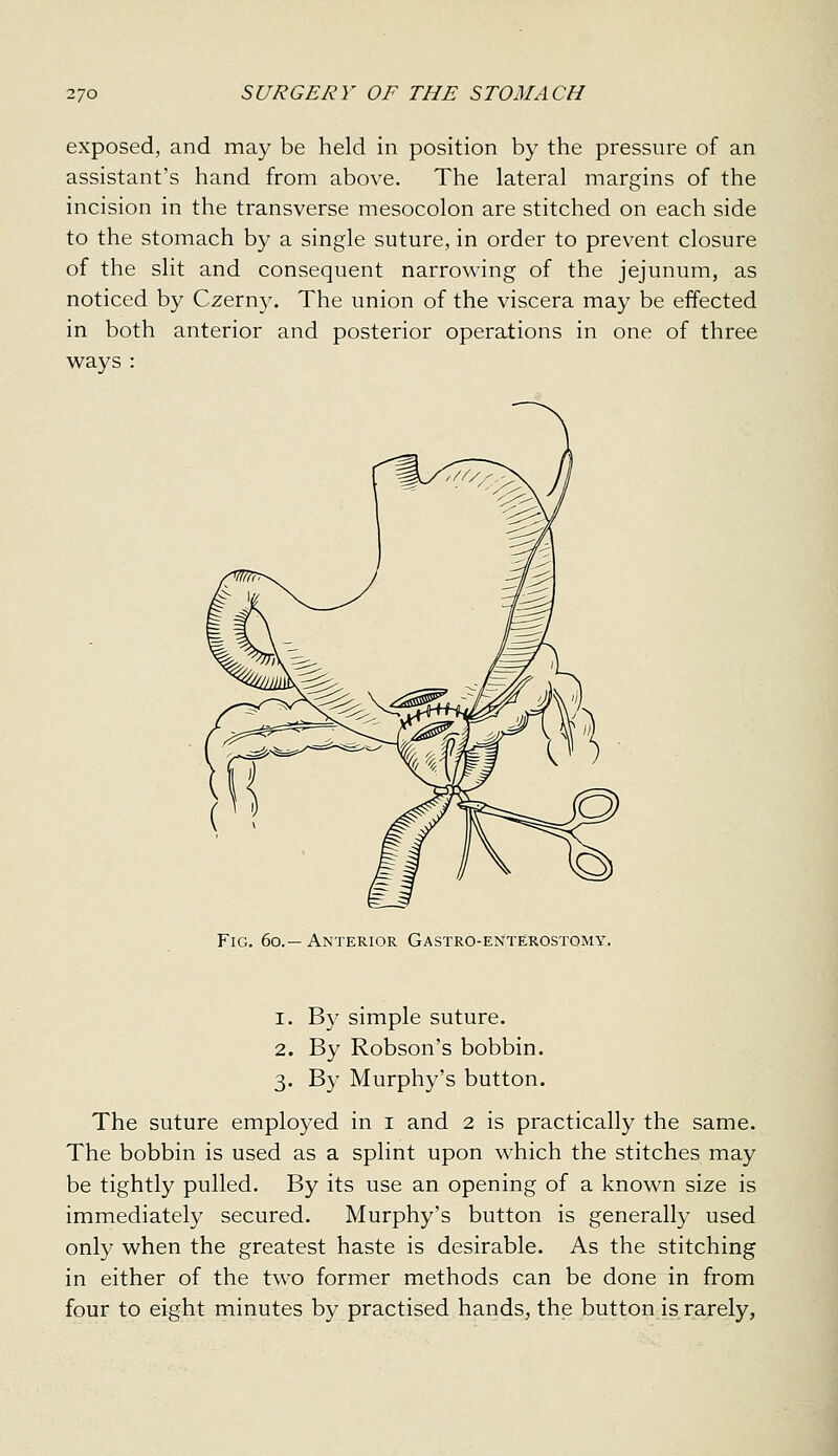 exposed, and may be held in position by the pressure of an assistant's hand from above. The lateral margins of the incision in the transverse mesocolon are stitched on each side to the stomach by a single suture, in order to prevent closure of the slit and consequent narrowing of the jejunum, as noticed by Czerny. The union of the viscera may be effected in both anterior and posterior operations in one of three ways : Fig. 6o.— Anterior Gastro-eNterostomy. 1. By simple suture. 2. By Robson's bobbin. 3. By Murphy's button. The suture employed in i and 2 is practically the same. The bobbin is used as a splint upon which the stitches may be tightly pulled. By its use an opening of a known size is immediately secured. Murphy's button is generally used only when the greatest haste is desirable. As the stitching in either of the two former methods can be done in from four to eight minutes by practised hands, the button is rarely,