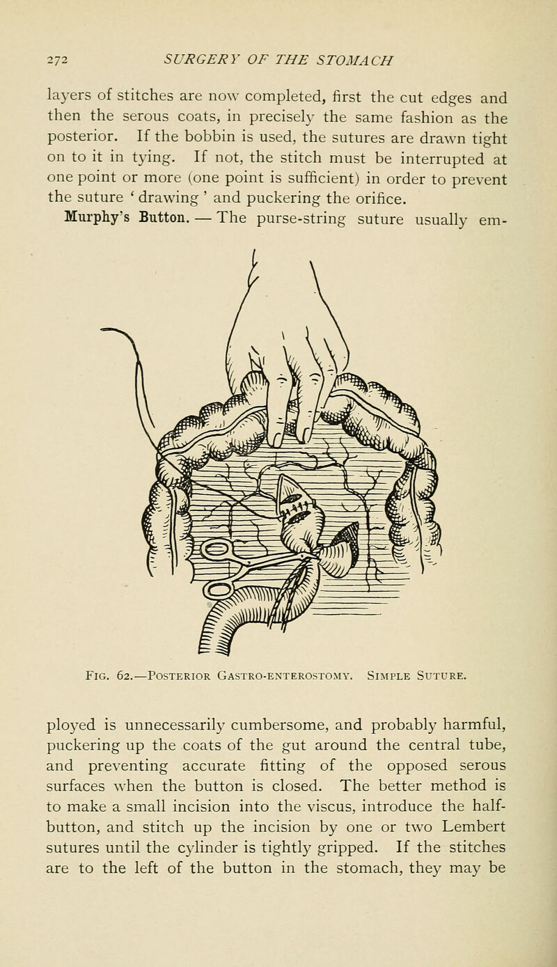 layers of stitches are now completed, first the cut edges and then the serous coats, in precisely the same fashion as the posterior. If the bobbin is used, the sutures are drawn tight on to it in tying. If not, the stitch must be interrupted at one point or more (one point is sufficient) in order to prevent the suture ' drawing ' and puckering the orifice. Murphy's Button. — The purse-string suture usually em- FiG. 62.—Posterior Gastro-enterostomy. Simple Suture. ployed is unnecessarily cumbersome, and probably harmful, puckering up the coats of the gut around the central tube, and preventing accurate fitting of the opposed serous surfaces when the button is closed. The better method is to make a small incision into the viscus, introduce the half- button, and stitch up the incision by one or two Lembert sutures until the cylinder is tightly gripped. If the stitches are to the left of the button in the stomach, they may be