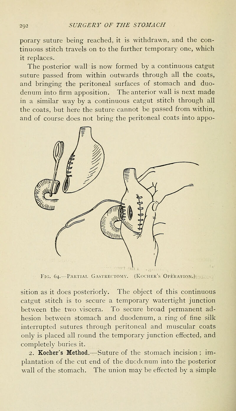 porary suture being reached, it is withdrawn, and the con- tinuous stitch travels on to the further temporar}- one, which it replaces. The posterior wall is now formed by a continuous catgut suture passed from within outwards through all the coats, and bringing the peritoneal surfaces of stomach and duo- denum into firm apposition. The anterior wall is next made in a similar way by a continuous catgut stitch through all the coats, but here the suture cannot be passed from within, and of course does not bring the peritoneal coats into appo- FiG. 64.—Partial Gastrectomy. (Kocher's Operation.) sition as it does posteriorly. The object of this continuous catgut stitch is to secure a temporary watertight junction between the two viscera. To secure broad permanent ad- hesion between stomach and duodenum, a ring of fine silk interrupted sutures through peritoneal and muscular coats only is placed all round the temporary junction effected, and completely buries it. 2. Kocher's Method.—Suture of the stomach incision ; im- plantation of the cut end of the duodenum into the posterior wall of the stomach. The union may be effected by a simple