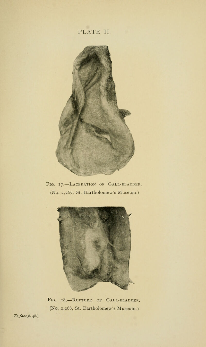 Fig. 17.—Laceration of Gall-bladder. (No. 2,267, St. Bartholomew's Museum.) Fig. iS.—Rupture of Gall-bladder. (No. 2,26s, St. Bartholomew's Museum.) To face p. 48.]