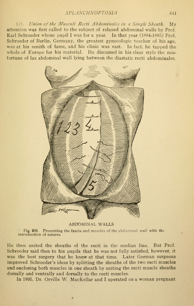 ( •■. Union of the Musculi Recti Ab dominates in a Single Sheath. My attention was first called to the subject of relaxed abdominal walls by Prof. Karl Schroeder whose pupil I was for a year. In that year (1884-1885) Prof. Schroeder of Berlin, Germany, the greatest gynecologic teacher of his age, was at his zenith of fame, and his clinic was vast. In fact, he tapped the whole of Europe for his material. He discussed in his clear style the mis- fortune of lax abdominal wall lying between the diastatic recti abdominales. ABDOMINAL WALLS Fig. 206. Presenting the fascia and muscles of the abdominal wall with the introduction of sutures. He then united the sheaths of the recti in the median line. But Prof. Schroeder said then to his pupils that he was not fully satisfied, however, it was the best surgery that he knew at that time. Later German surgeons improved Schroeder's ideas by splitting the sheaths of the two recti muscles and enclosing both muscles in one sheath by uniting the recti muscle sheaths dorsally and ventrally and dorsally to the recti muscles. In 1895, Dr. Orville W. MacKellar and I operated on a woman pregnant