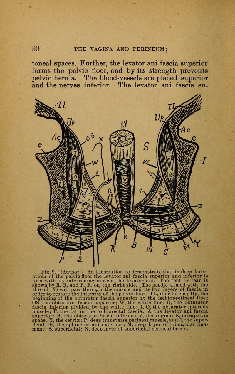 toneal spaces. Further, the levator ani fascia superior forms the pelvic floor, and by its strength prevents pelvic hernia. The blood-vessels are placed sijperior and the nerves inferior. The levator ani fascia su- Fig. 9.—(Author.) An illustration to demonstrate that in deep lacer- ations of the pelvic floor the levator ani fascia superior and inferior is torn with its intervening muscle, the levator ani. The rent or tear is shown by R, R, and R, R, on the right side. The needle armed with the thread (X) will pass through the muscle and its two layers of fascia in order to restore the integrity of the pelvic floor. XL, iliac fascia; Up, the beginning of the obturator fascia superior at the ischiopectineal line; OS, the obturator fascia superior; W, the white line; O, the obturator fascia inferior divided by the white line; I. O, the obturator internus muscle; F, the fat in the ischiorectal fascia; A, the levator ani fascia superior; B, the obturator fascia inferior; V, the vagina; S, intrapelvic space; Y, the cervix; P, deep transverse perineal muscle, and 2, the super- ficial; B, the sphincter ani externus; M, deep layer of triangular liga- ment; S, superficial; N, deep layer of superficial perineal fascia.