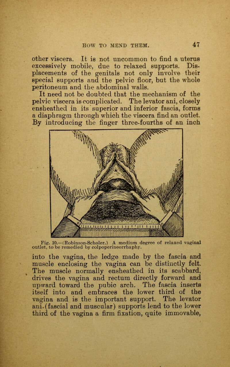 other viscera. It is not uncommon to find a uterus excessively mobile, due to relaxed supports. Dis- placements of the genitals not only involve their special supports and the pelvic floor, but the whole peritoneum and the abdominal walls. It need not be doubted that the mechanism of the pelvic viscera is complicated. The levator ani, closely ensheathed in its superior and inferior fascia, forms a diaphragm through which the viscera find an outlet. By introducing the finger three-fourths of an inch Fig. 10.—(Eobinson-Scholer.) A medium degree of relaxed vaginal outlet, to be remedied by colpoperineorrhaphy. into the vagina, the ledge made by the fascia and muscle enclosing the vagina can be distinctly felt. The muscle normally ensheathed in its scabbard, drives the vagina and rectum directly forward and upward toward the pubic arch. The fascia inserts itself into and embraces the lower third of the vagina and is the important support. The levator ani.(fascial and muscular) supports lend to the lower third of the vagina a firm fixation, quite immovable,