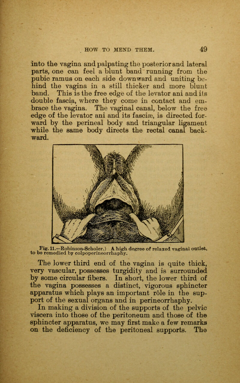 into the vagina and palpating the i^osterior and lateral parts, one can feel a blunt band running from the pubic ramus on each side downward and uniting be- hind the vagina in a still thicker and more blunt band. This is the free edge of the levator ani and its double fascia, where they come in contact and em- brace the vagina. The vaginal canal, below the free edge of the levator ani and its fascise, is directed for- ward by the perineal body and triangular ligament vrhile the same body directs the rectal canal back- ward. Fig. 11.—Robinson-Scholer.) A high degree of relaxed vaginal outlet, to be remedied by colpoperineorrhaphy. The lower third end of the vagina is quite thick, very vascular, possesses turgidity and is surrounded by some circular fibers. In short, the lower third of the vagina possesses a distinct, vigorous sphincter apparatus which plays an important r6le in the sup- port of the sexual organs and in perineorrhaphy. In making a division of the supports of the pelvic viscera into those of the peritoneum and those of the sphincter apparatus, we may first make a few remarks on the deficiency of the peritoneal supports. The