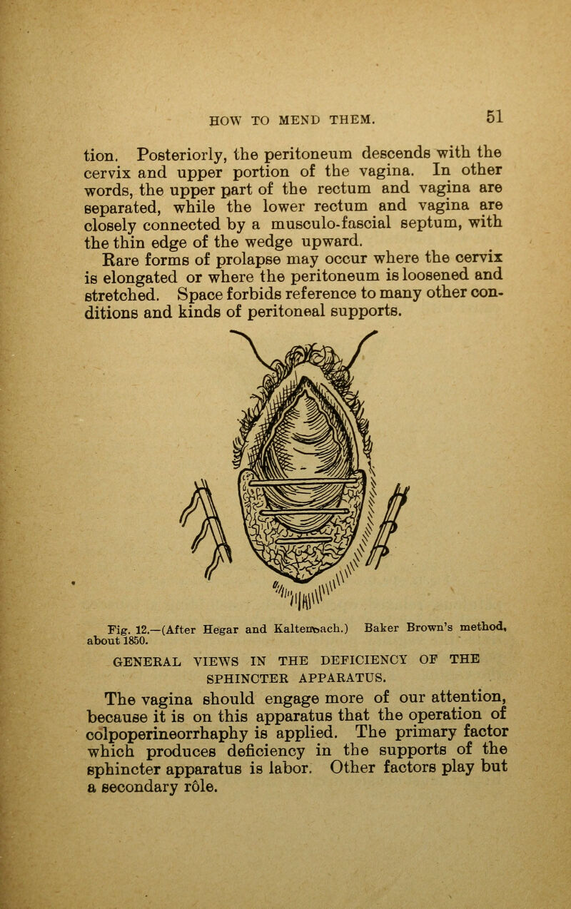 tion. Posteriorly, the peritoneum descends with the cervix and upper portion of the vagina. In other words, the upper part of the rectum and vagina are separated, while the lower rectum and vagina are closely connected by a musculo-fascial septum, with the thin edge of the wedge upward. Rare forms of prolapse may occur where the cervix is elongated or where the peritoneum is loosened and stretched. Space forbids reference to many other con- ditions and kinds of peritoneal supports. Fig. 12.—(After Hegar and Kaltentoach.) Baker Brown's method, about 1850. GENERAL VIEWS IN THE DEFICIENCY OF THE SPHINCTER APPARATUS. The vagina should engage more of our attention, because it is on this apparatus that the operation of colpoperineorrhaphy is applied. The primary factor which produces deficiency in the supports of the sphincter apparatus is labor. Other factors play but a secondary role.