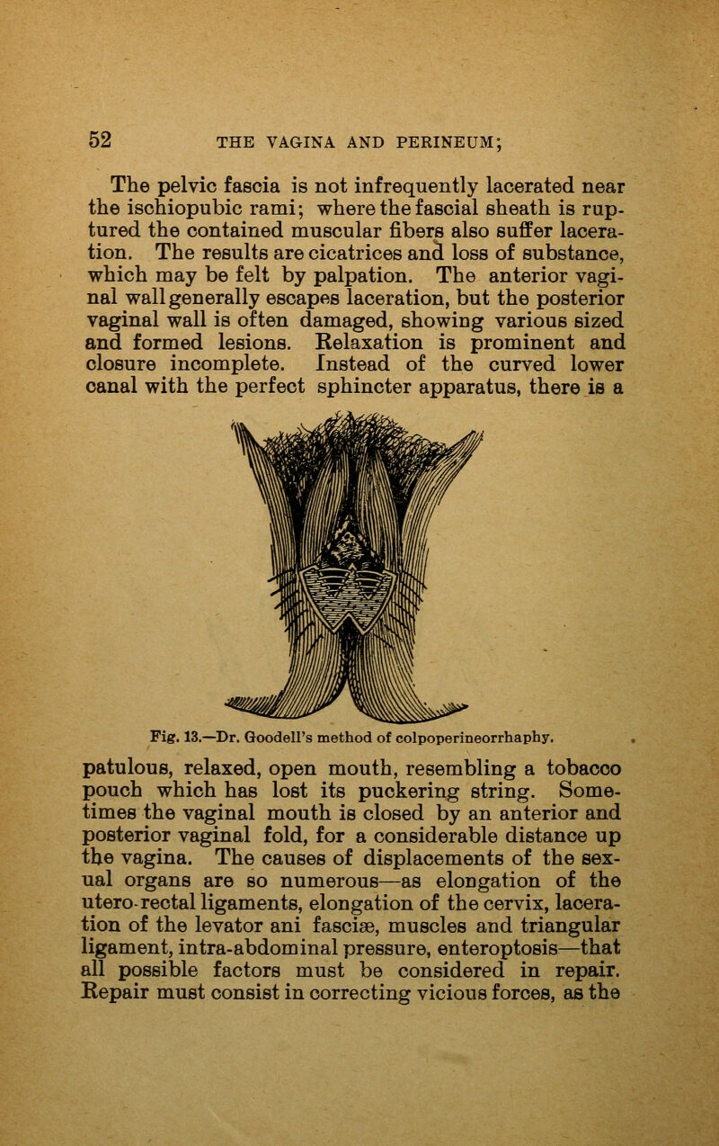 The pelvic fascia is not infrequently lacerated near the ischiopubic rami; where the fascial sheath is rup- tured the contained muscular fibers also suffer lacera- tion. The results are cicatrices and loss of substance, which may be felt by palpation. The anterior vagi- nal wall generally escapes laceration, but the posterior vaginal wall is often damaged, showing various sized and formed lesions. Relaxation is prominent and closure incomplete. Instead of the curved lower canal with the perfect sphincter apparatus, there is a Fig. 13.—Dr. Goodell's method of colpoperineorrhaphy. patulous, relaxed, open mouth, resembling a tobacco pouch which has lost its puckering string. Some- times the vaginal mouth is closed by an anterior and posterior vaginal fold, for a considerable distance up the vagina. The causes of displacements of the sex- ual organs are so numerous—as elongation of the uterO'rectal ligaments, elongation of the cervix, lacera- tion of the levator ani fasciae, muscles and triangular ligament, intra-abdominal pressure, enteroptosis—that all possible factors must be considered in repair. Repair must consist in correcting vicious forces, as the