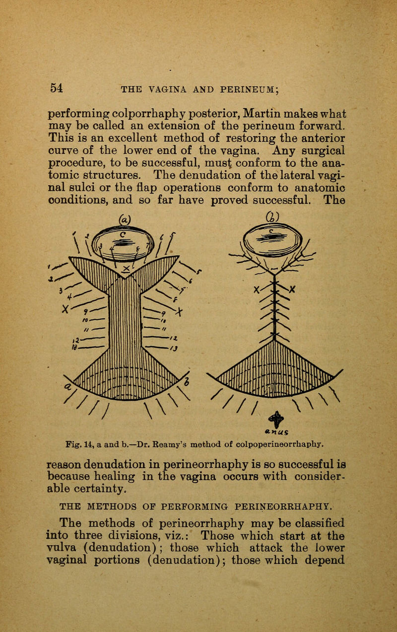 performing colporrhaphy posterior, Martin makes what may be called an extension of the perineum forward. This is an excellent method of restoring the anterior curve of the lower end of the vagina. Any surgical procedure, to be successful, must conform to the ana- tomic structures. The denudation of the lateral vagi- nal sulci or the flap operations conform to anatomic conditions, and so far have proved successful. The a) ^nus Fig. 14, a and b.—Dr. Kearny's method of colpoperineorrhaphy. reason denudation in perineorrhaphy is so successful is because healing in the vagina occurs with consider- able certainty. THE METHODS OF PERFORMING PERINEORRHAPHY. The methods of perineorrhaphy may be classified into three divisions, viz.: Those which start at the vulva (denudation) ; those which attack the lower vaginal portions (denudation); those which depend