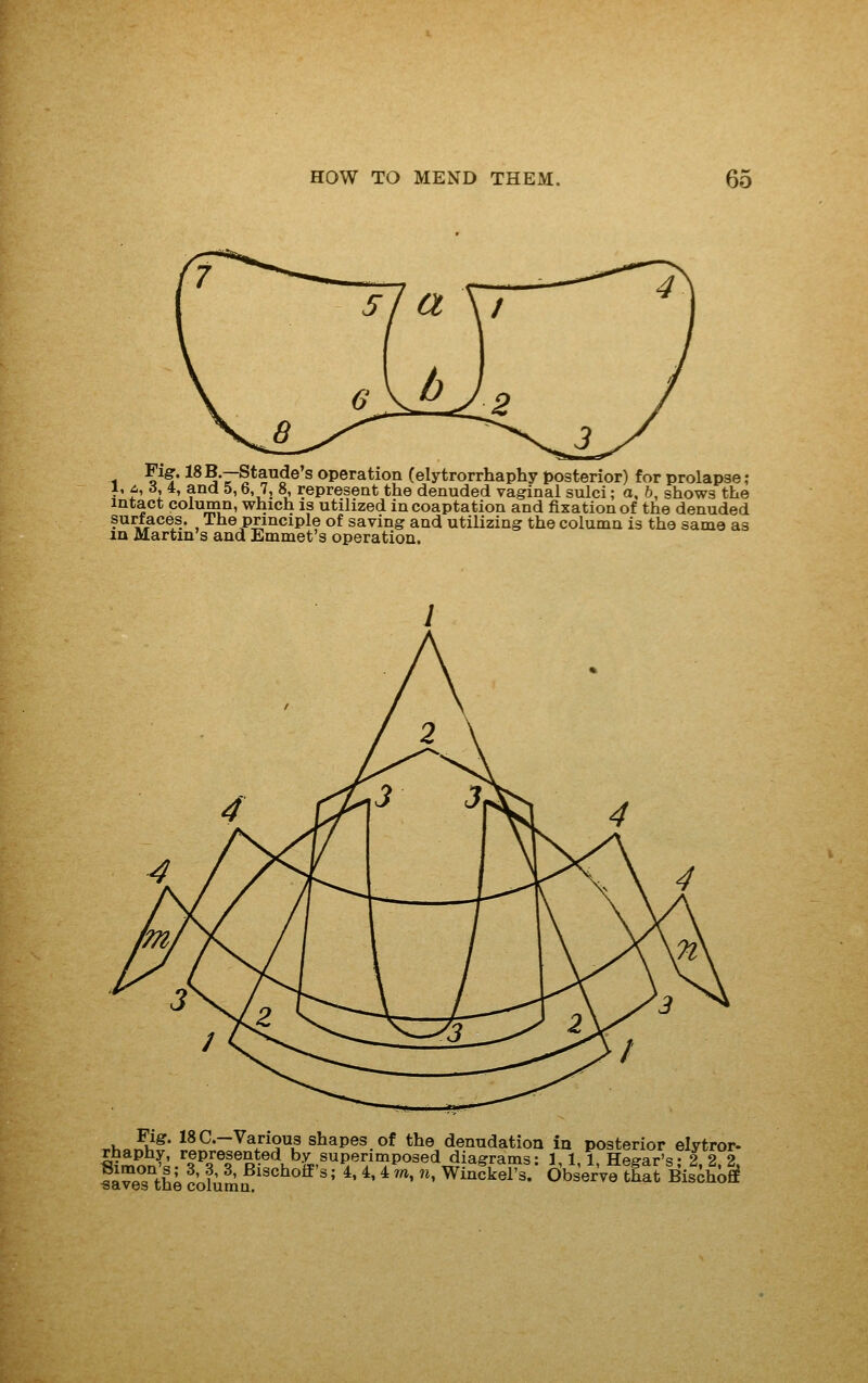 Fig. 18 B.—Staude s operation (elytrorrhaphy posterior) for prolapse; 1, £., 6, 4, and 5,6, 7, 8, represent the denuded vaginal sulci; a, 5, shows the intact column, which is utilized in coaptation and fixation of the denuded surfaces. The principle of saving and utilizing the column is the same as in Martin's and Emmet's operation. .KoS^* 18C-Various shapes of the denudation in posterior elytror- rhaphy, represented by superimposed diagrams: 1,1 1 He^ar's- 2 2 2 faXthlcolum^ ^^'*^''' ^'^'^^^.'^ Winfkel's. Observe thtt BischoS