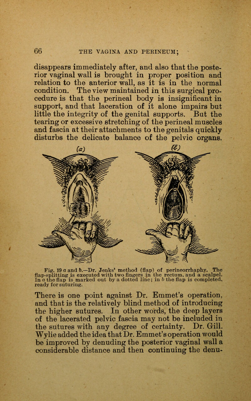 disappears immediately after, and also that the poste- rior vaginal wall is brought in proper position and relation to the anterior wall, as it is in the normal condition. The view maintained in this surgical pro- cedure is that the perineal body is insignificant in support, and that laceration of it alone impairs but little the integrity of the genital supports. But the tearing or excessive stretching of the perineal muscles and fascia at their attachments to the genitals quickly disturbs the delicate balance of the pelvic organs. (a) m Fig. 19 a and 5.—Dr. Jenks' method (flap) of perineorrhaphy. The flap-splitting is executed with two fingers in the rectum, and a scalpel. In a the flap is marked out by a dotted line; in b the flap is completed, ready for suturing. There is one point against Dr. Emmet's operation, and that is the relatively blind method of introducing the higher sutures. In other words, the deep layers of the lacerated pelvic fascia may not be included in the sutures with any degree of certainty. Dr. Gill. Wylie added the idea that Dr. Emmet's operation would be improved by denuding the posterior vaginal wall a considerable distance and then continuing the denu-