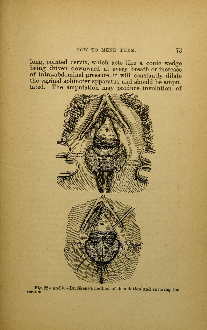 long, pointed cervix, which acts like a conic wedge being driven downward at every breath or increase of intra-abdominal pressure, it will constantly dilate the vaginal sphincter apparatus and should be ampu- tated. The amputation may produce involution of Fig. 22 a and b.—Dr. Skene's naethod of denudation' and suturine the rectum. I'^x^-s fuo