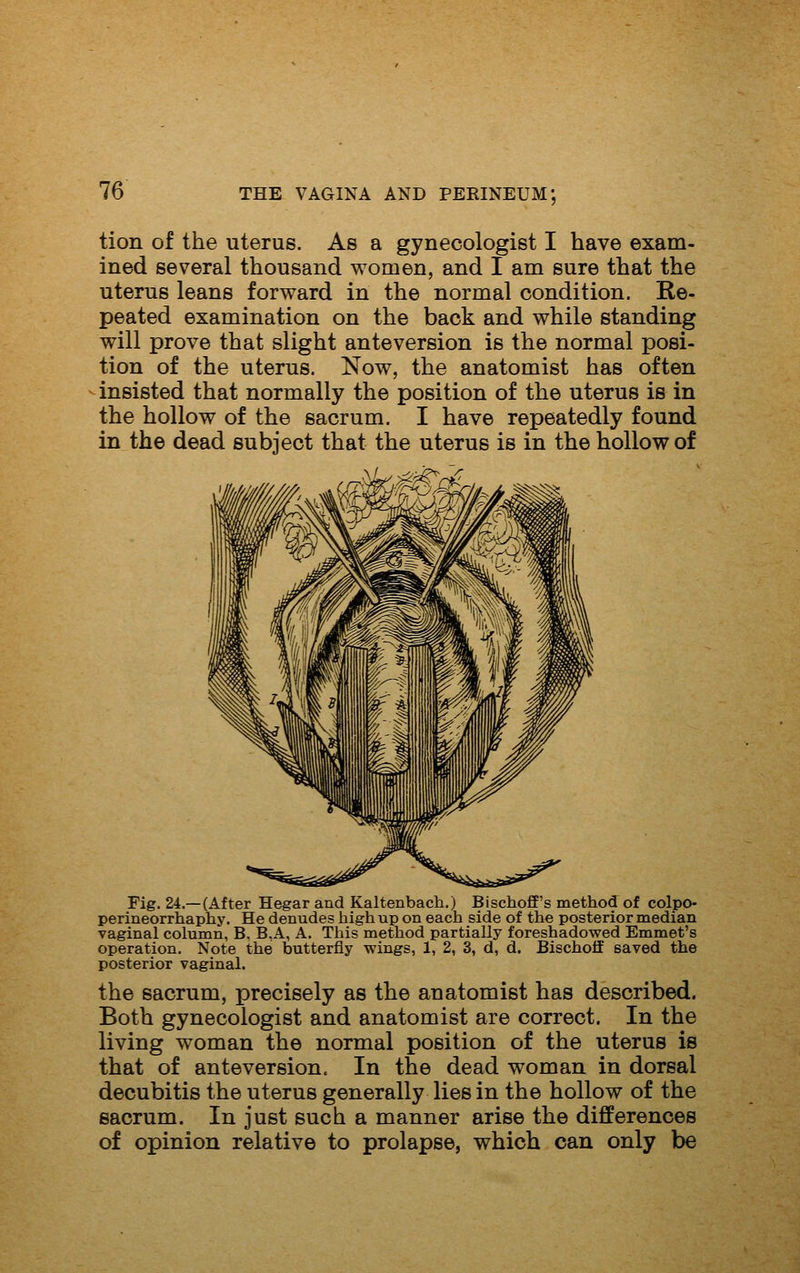 tion of the uterus. As a gynecologist I have exam- ined several thousand women, and I am sure that the uterus leans forward in the normal condition. Re- peated examination on the back and while standing will prove that slight ante version is the normal posi- tion of the uterus. Now, the anatomist has often insisted that normally the position of the uterus is in the hollow of the sacrum. I have repeatedly found in the dead subject that the uterus is in the hollow of Pig. 24.—(After Hegar and Kaltenbach.) BischofE's method of colpo- perineorrhaphy. He denudes high up on each side of the posterior median vaginal column, B, B,A, A. This method partially foreshadowed Emmet's operation. Note the butterfly wings, 1, 2, 3, d, d. Bischoff saved the posterior vaginal. the sacrum, precisely as the anatomist has described. Both gynecologist and anatomist are correct. In the living woman the normal position of the uterus is that of anteversion. In the dead woman in dorsal decubitis the uterus generally lies in the hollow of the sacrum. In just such a manner arise the differences of opinion relative to prolapse, which can only be