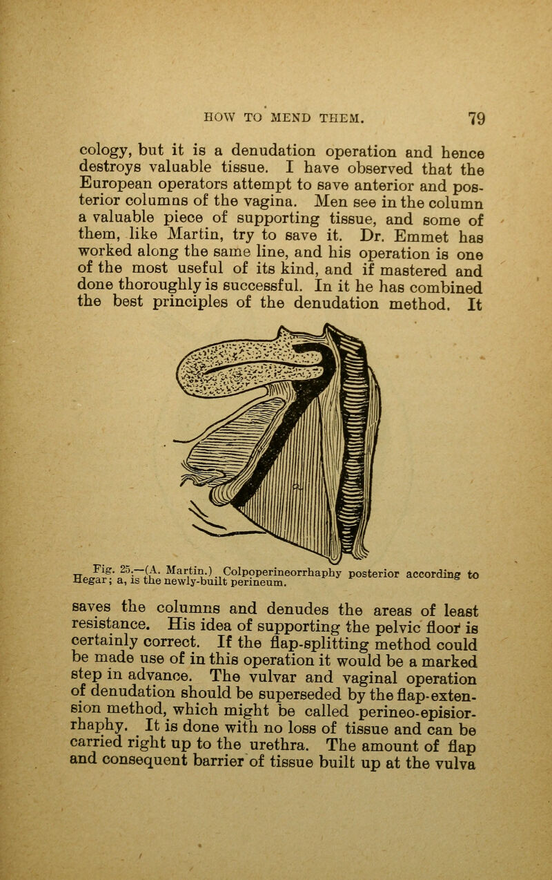 cology, but it is a denudation operation and hence destroys valuable tissue. I have observed that the European operators attempt to save anterior and pos- terior columns of the vagina. Men see in the column a valuable piece of supporting tissue, and some of them, like Martin, try to save it. Dr. Emmet has worked along the same line, and his operation is one of the most useful of its kind, and if mastered and done thoroughly is successful. In it he has combined the best principles of the denudation method. It Fig. 25.—(A. Martin.) Colpoperineorrhaphy posterior accordina- to Hegar; a, IS the newly-built perineum. ^ saves the columns and denudes the areas of least resistance. His idea of supporting the pelvic floor' is certainly correct. If the flap-splitting method could be made use of in this operation it would be a marked step in advance. The vulvar and vaginal operation of denudation should be superseded by theflap-exten- sion method, which might be called perineo-episior- rhaphy. It is done with no loss of tissue and can be carried right up to the urethra. The amount of flap and consequent barrier of tissue built up at the vulva