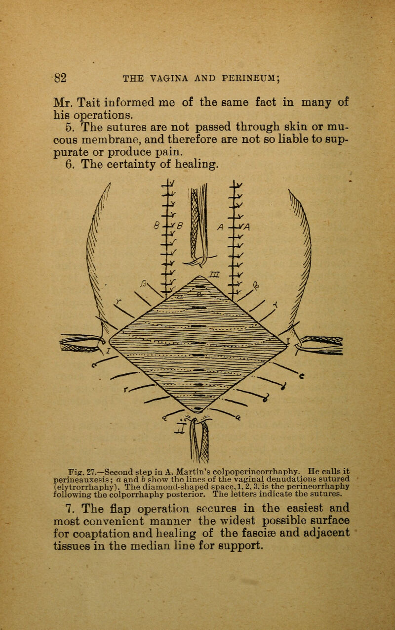 Mr. Tait informed me of the same fact in many of his operations. 5. The sutures are not passed through skin or mu- cous membrane, and therefore are not so liable to sup- purate or produce pain. 6. The certainty of healing. Fig. 27.—Second step in A. Martin's colpoperineorrhaphy. He calls it perineauxesis; a and b show the lines of the vaginal denudations sutured (elytrorrhaphy). The diamond-shaped space, 1, 2,3, is the perineorrhaphy following the colporrhaphy posterior. The letters indicate the sutures. 7. The flap operation secures in the easiest and most convenient manner the widest possible surface for coaptation and healing of the fasciae and adjacent tissues in the median line for support.
