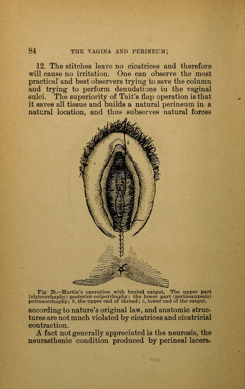 12. The stitches leave no cicatrices and therefore will cause no irritation. One can observe the most practical and best observers trying to save the column and trying to perform denudations in the vaginal sulci. The superiority of Tait's flap operation is that it saves all tissue and builds a natural perineum in a natural location, and thus subserves natural forces Fig. 29.—Martin's operation with buried catgut, The upper part (elytrorrhaphy) posterior colporrhaphy; the lower part (perineauxesis) perineorrhaphy; 6, the upper end of thread; c, lower end of the catgut. according to nature's original law, and anatomic struc- tures are not much violated by cicatrices and cicatricial contraction. A fact not generally appreciated is the neurosis, the neurasthenic condition produced by perineal lacera-