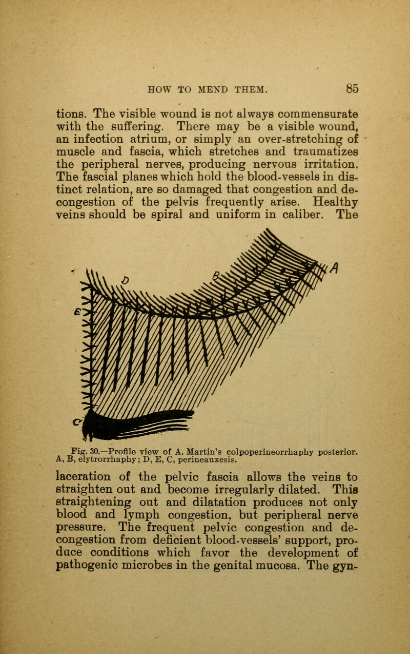 tions. The visible wound is not always commensurate with the suflPering. There may be a visible wound, an infection atrium, or simply an over-stretching of muscle and fascia, which stretches and traumatizes the peripheral nerves, producing nervous irritation. The fascial planes which hold the blood-vessels in dis- tinct relation, are so damaged that congestion and de- congestion of the pelvis frequently arise. Healthy veins should be spiral and uniform in caliber. The Fig. 30.—Profile view of A. Martin's colpoperineorrhaphy posterior. A, B, elytrorrhaphy; D, E, C, perineauxesis. laceration of the pelvic fascia allows the veins to straighten out and become irregularly dilated. This straightening out and dilatation produces not only blood and lymph congestion, but peripheral nerve pressure. The frequent pelvic congestion and de- congestion from deficient blood-vessels' support, pro- duce conditions which favor the development of pathogenic microbes in the genital mucosa. The gyn-