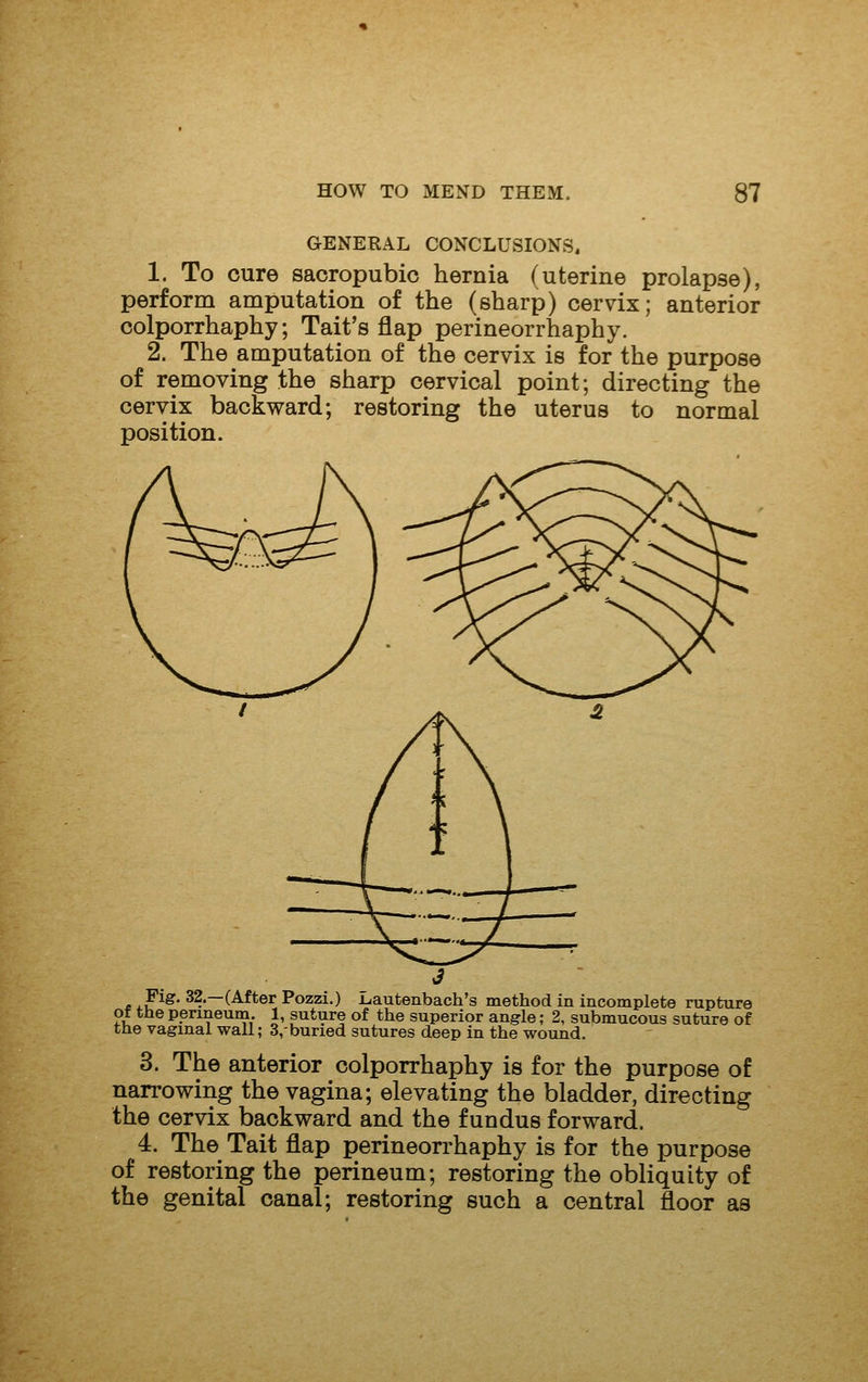 GENERAL CONCLUSIONS. 1. To cure saoropubio hernia (uterine prolapse), perform amputation of the (sharp) cervix; anterior oolporrhaphy; Tait's flap perineorrhaphy. 2. The amputation of the cervix is for the purpose of removing the sharp cervical point; directing the cervix backward; restoring the uterus to normal position. Pig. 32.—(After Pozzi.) i^autenbach's method in incomplete rupture of tHeperineum. 1, suture of the superior angle; 2, submucous suture of the vaginal wall; 3,-buried sutures deep in the wound. 3. The anterior colporrhaphy is for the purpose of narrowing the vagina; elevating the bladder, directing the cervix backward and the fundus forward. 4. The Tait flap perineorrhaphy is for the purpose of restoring the perineum; restoring the obliquity of the genital canal; restoring such a central floor as