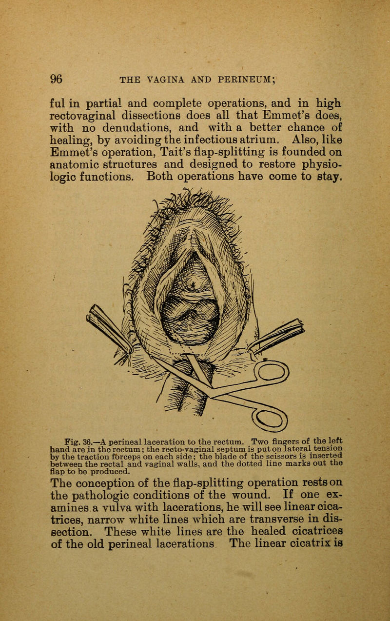 ful in partial and complete operations, and in high rectovaginal dissections does all that Emmet's does, with no denudations, and with a better chance of healing, by avoiding the infectious atrium. Also, like Emmet's operation, Tait's flap-splitting is founded on anatomic structures and designed to restore physio- logic functions. Both operations have come to stay. Fig. 36.—A perineal laceration to the rectum. Two fingers of the left hand are in the rectum; the recto-vaginal septum is put on lateral tension by the traction fbrceps on each side; the blade of the scissors is inserted between the rectal and vaginal walls, and the dotted line marks out the flap to be produced. The conception of the flap-splitting operation rests on the pathologic conditions of the wound. If one ex- amines a vulva with lacerations, he will see linear cica- trices, narrow white lines which are transverse in dis- section. These white lines are the healed cicatrices of the old perineal lacerations The linear cicatrix is