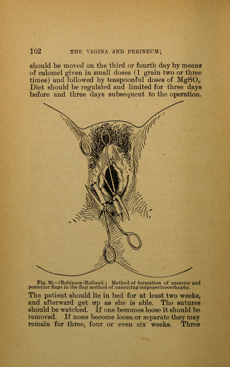 should be moved on the third or fourth day by means of calomel given in small doses (1 grain two or three times) and followed by teaspoonful doses of MgSOi. Diet should be regulated and limited for three days before and three days subsequent to the operation. Fig. 39.—(Eobinson-Holland.) Method of formation of anterior and posterior flaps in the flap method of executing colpoperineorrhaphy. The patient should lie in bed for at least two weeks, and afterward get up as she is able. The sutures should be watched. If one becomes loose it should be removed. If none become ioosa or separate they may remain for three, four or even six weeks. Three