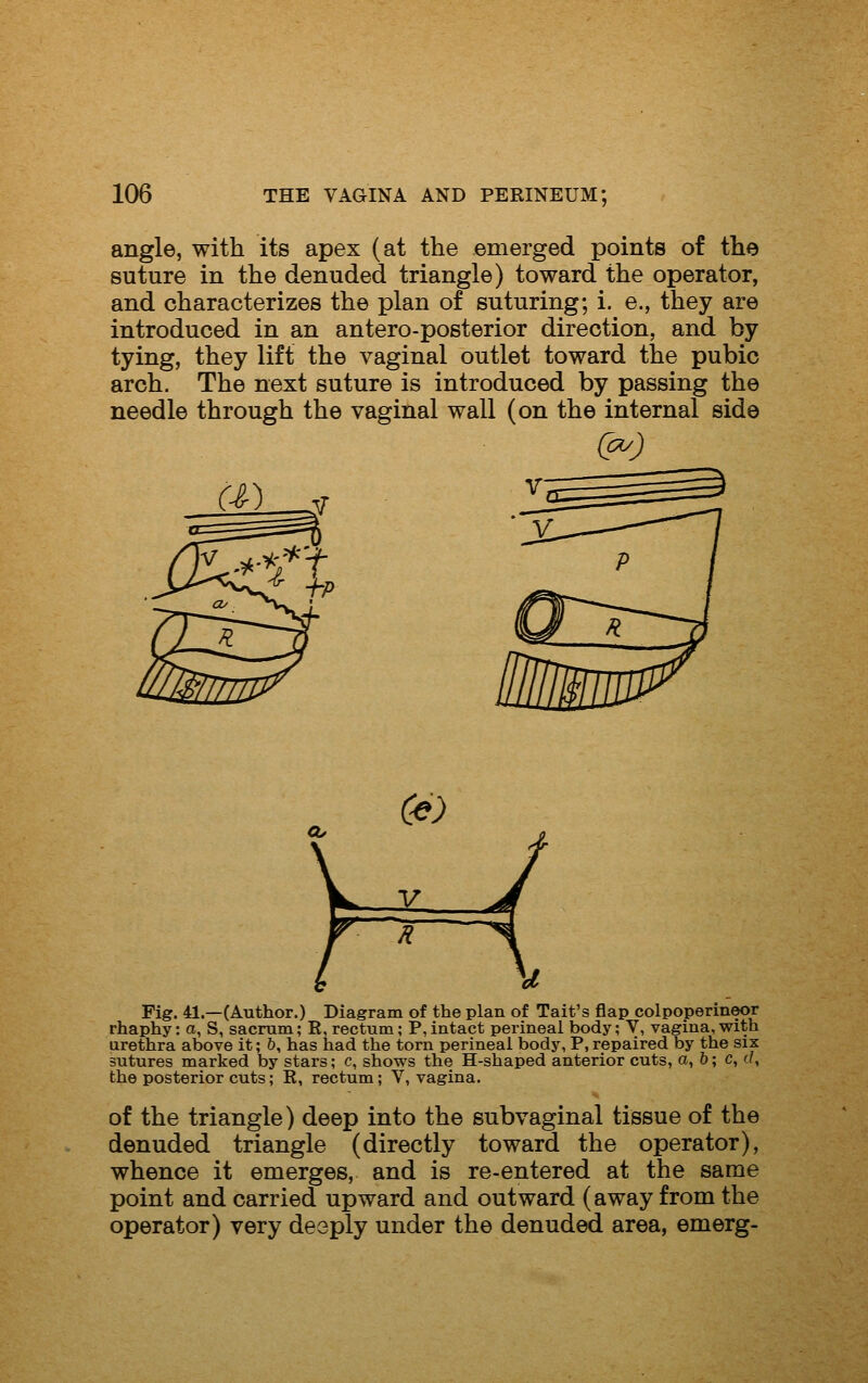 angle, with its apex (at the emerged points of the suture in the denuded triangle) toward the operator, and characterizes the plan of suturing; i. e., they are introduced in an antero-posterior direction, and by tying, they lift the vaginal outlet toward the pubic arch. The next suture is introduced by passing the needle through the vaginal wall (on the internal side Fig. 41.—(Author.) Diagram of the plan of Tait's flap colpoperineor rhaphy: a, S, sacrum; R, rectum; P, intact perineal body; V, vagina, with urethra above it; &, has had the torn perineal body, P, repaired by the six sutures marked by stars; c, shows the H-shaped anterior cuts, a, 6; c, (/, the posterior cuts; R, rectum; V, vagina. of the triangle) deep into the subvaginal tissue of the denuded triangle (directly toward the operator), whence it emerges, and is re-entered at the same point and carried upward and outward (away from the operator) very deeply under the denuded area, emerg-