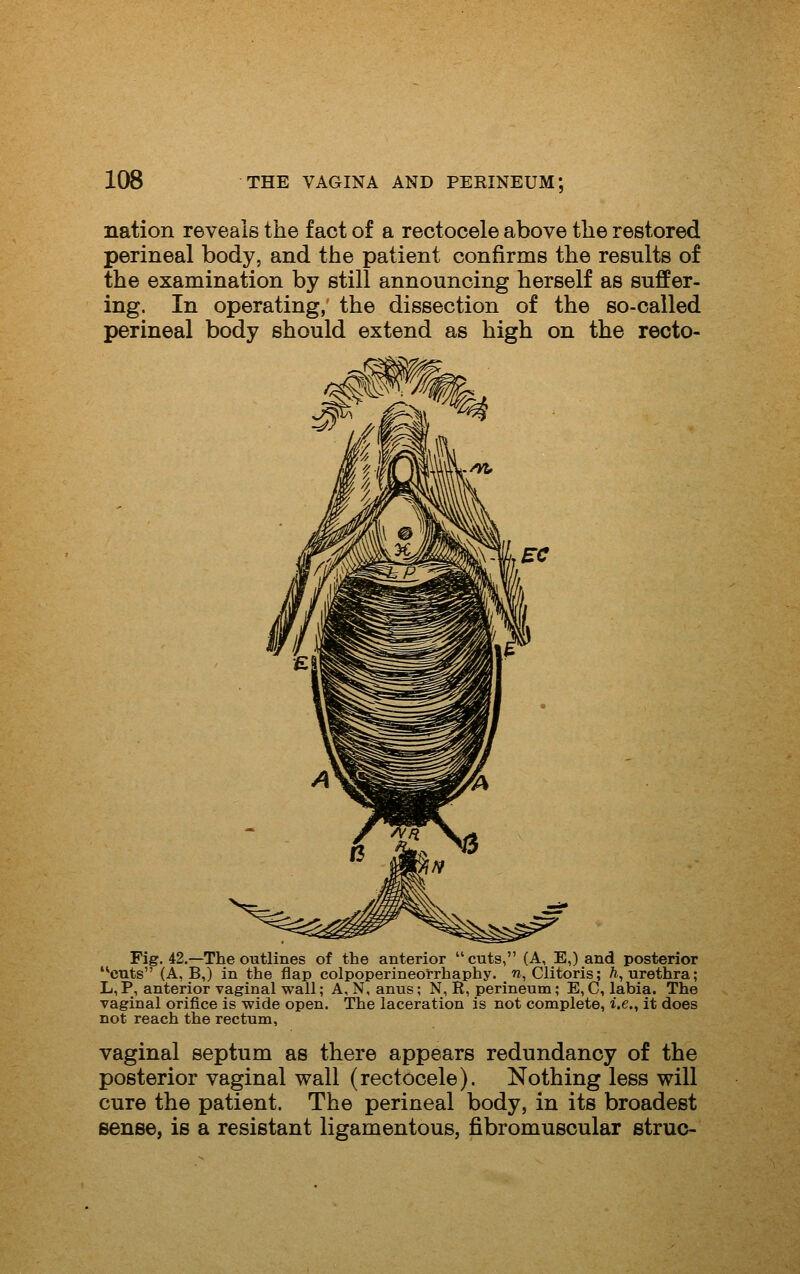 nation reveals the fact of a reotocele above the restored perineal body, and the patient confirms the results of the examination by still announcing herself as suffer- ing. In operating, the dissection of the so-called perineal body should extend as high on the recto- Fig. 42.—The outlines of the anterior cuts, (A, E,) and posterior '*cuts (A, B,) in the flap colpoperineorrhaphy. to, Clitoris; /i, urethra; L, P, anterior vaginal wall; A, N, anus; N, R, perineum; E, C, labia. The vaginal orifice is wide open. The laceration is not complete, i.e., it does not reach the rectum, vaginal septum as there appears redundancy of the posterior vaginal wall (rectocele). Nothing less will cure the patient. The perineal body, in its broadest sense, is a resistant ligamentous, fibromuscular struo-