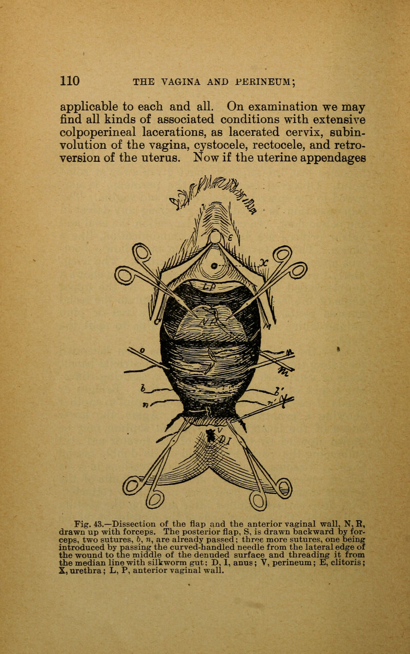 applicable to each and all. On examination we may find all kinds of associated conditions with extensive colpoperineal lacerations, as lacerated cervix, subin- volution of the vagina, cystocele, rectocele, and retro- version of the uterus. Now if the uterine appendages Fig. 43.—Dissection of the flap and the anterior vaginal wall, N,R, drawn up with forceps. The posterior flap, S, is drawn backward by for- ceps, two sutures, 6, n, are already passed; three more sutures, one being introduced by passing the curved-handled needle from the lateral edge of the wound to the middle of the denuded surface and threading it from the median line with silkworm gut; D, I, anus; V, perineum; E, clitoris; X, urethra; L, P, anterior vaginal wall.