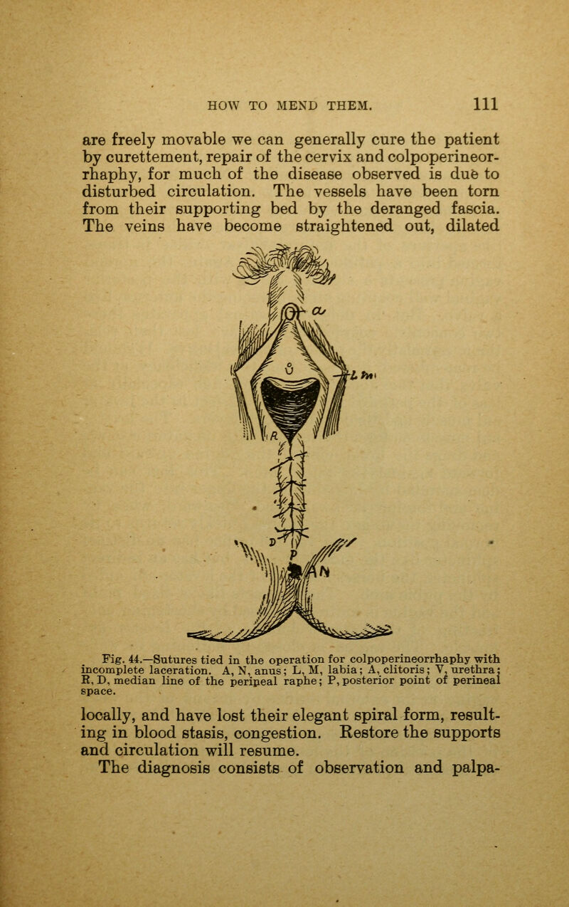 are freely movable we can generally cure the patient by curettement, repair of the cervix and colpoperineor- rhaphy, for much of the disease observed is du6 to disturbed circulation. The vessels have been torn from their supporting bed by the deranged fascia. The veins have become straightened out, dilated Pig. 44.—Sutures tied in the operation for colpoperineorrhaphy with incomplete laceration. A, N, anus; L, M, labia; A, clitoris; V, urethra: E,D, median line of the peripeal raphe; P, posterior point of perineal space. locally, and have lost their elegant spiral form, result- ing in blood stasis, congestion. Restore the supports and circulation will resume. The diagnosis consists of observation and palpa-