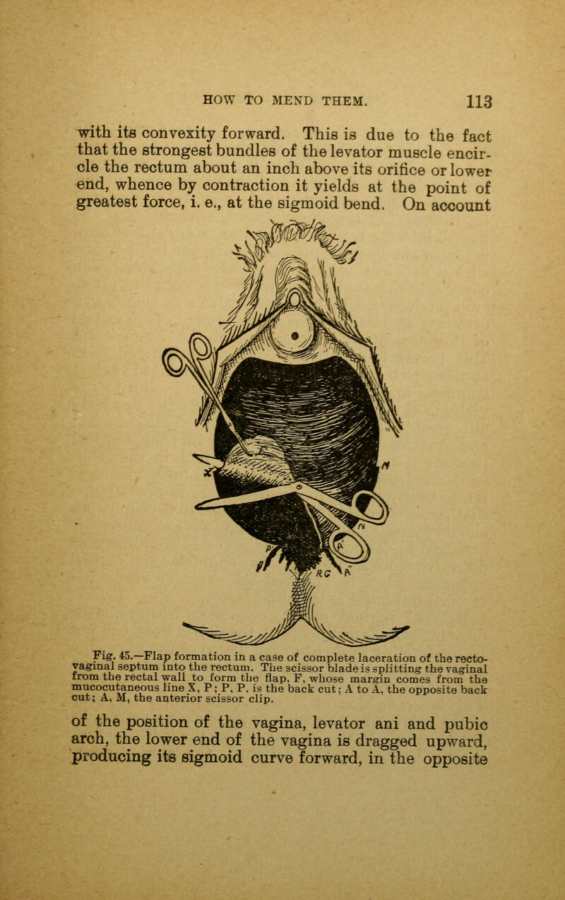 with its convexity forward. This is due to the fact that the strongest bundles of the levator muscle encir- cle the rectum about an inch above its orifice or lower end, whence by contraction it yields at the point of greatest force, i. e., at the sigmoid bend. On account Figr. 45,—Flap formation in a case of complete laceration of the recto- vaginal septum into the rectum. The scissor blade is splitting the vaginal from the rectal wall to form the flap, F, whose margin comes from the mucocutaneous line X, P; P, P, is the back cut; A to A, the opposite back cut; A, M, the anterior scissor clip, of the position of the vagina, levator ani and pubic arch, the lower end of the vagina is dragged upward, producing its sigmoid curve forward, in the opposite