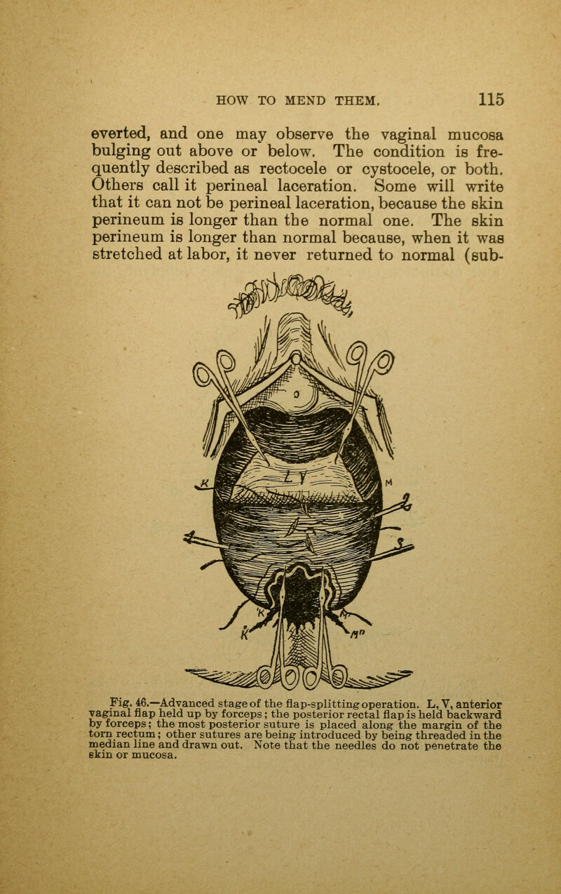 everted, and one may observe the vaginal mucosa bulging out above or below. The condition is fre- quently described as rectocele or cystocele, or both. Others call it perineal laceration. Some will write that it can not be perineal laceration, because the skin perineum is longer than the normal one. The skin perineum is longer than normal because, when it was stretched at labor, it never returned to normal (sub- Fig. 46.—Advanced stage of the flap-splitting operation. L, V, anterior vaginal flap held up by forceps; the posterior rectal flap is held backward by forceps; the most posterior suture is placed along the margin of the torn rectum; other sutures are being introduced by being threaded in the median line and drawn out. Note that the needles do not penetrate the ekin or mucosa.