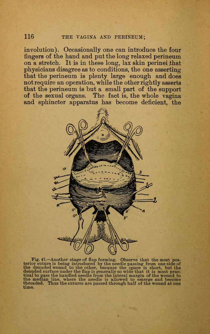 involution). Occasionally one can introduce the four fingers of the hand and put the long relaxed perineum on a stretch. It is in these long, lax skin perinei .that physicians disagree as to conditions, the one asserting that the perineum is plenty large enough and does not require an operation, while the other rightly asserts that the perineum is but a small part of the support of the sexual organs. The fact is, the whole vagina and sphincter apparatus has become deficient, the Fig. 47.—Another stage of flap forming. Observe that the most pos- terior suture is being introduced by the needle passing from one side of the denuded wound to the other, because the space is short, but the denuded surface under the flap is generally so wide that it is most prac- tical to pass the handled needle from the lateral margin of the wound to the median line, where the needle is allowed to emerge and become threaded. Thus the sutures are passed through half of the wound at one time.