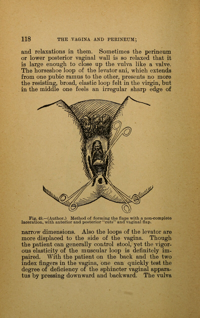 and relaxations in them. Sometimes the perineum or lower posterior vaginal wall is so relaxed that it is large enough to close up the vulva like a valve. The horseshoe loop of the levator ani, which extends from one pubic ramus to the other, presents no more the resisting, broad, elastic loop felt in the virgin, but in the middle one feels an irregular sharp edge of Fig. 49.—(Author.) Method of forming the flaps with a non-complete laceration, with anterior and posterior cuts and vaginal flap. narrow dimensions. Also the loops of the levator are more displaced to the side of the vagina. Though the patient can generally control stool, yet the vigor- ous elasticity of the muscular loop is definitely im- paired. With the patient on the back and the two index fingers in the vagina, one can quickly test the degree of deficiency of the sphincter vaginal appara- tus by pressing downward and backward. The vulva