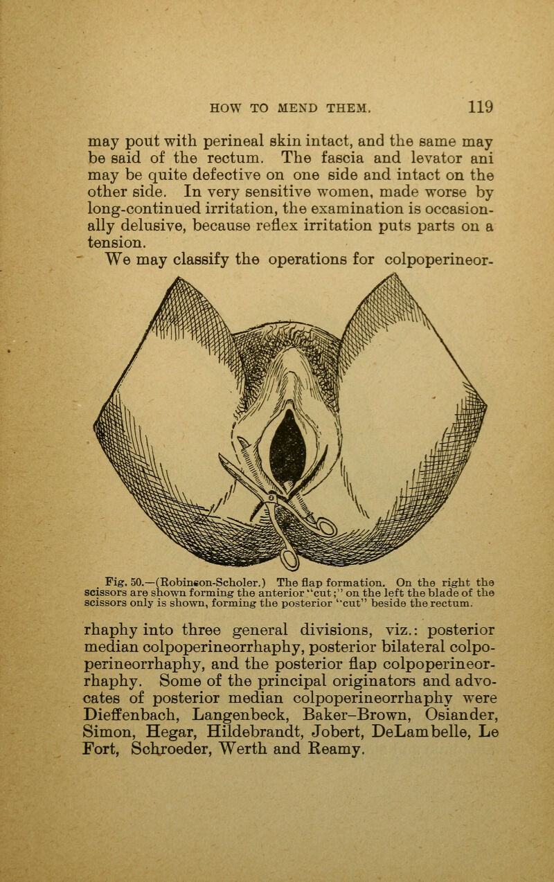 may pout with perineal skin intact, and the same may be said of the rectum. The fascia and levator ani may be quite defective on one side and intact on the other side. In very sensitive women, made worse by long-continued irritation, the examination is occasion- ally delusive, because reflex irritation puts parts on a tension. We may classify the operations for colpoperineor- _ Fig. 50.—(Eobinson-Sclaoler,) The flap formation. On the right the scissors are shown forming the anterior cut; on the left the blade of the scissors only is shown, forming the posterior 'cut beside the rectum. rhaphy into three general divisions, viz.: posterior median oolpoperineorrhaphy, posterior bilateral colpo- perineorrhaphy, and the posterior flap oolpoperineor- rhaphy. Some of the principal originators and advo- cates of posterior median oolpoperineorrhaphy were Dieffenbach, Langenbeck, Baker-Brown, Osiander, Simon, Hegar, Hildebrandt, Jobert, DeLam belle, Le Fort, Sohjoeder, Werth and Reamy.