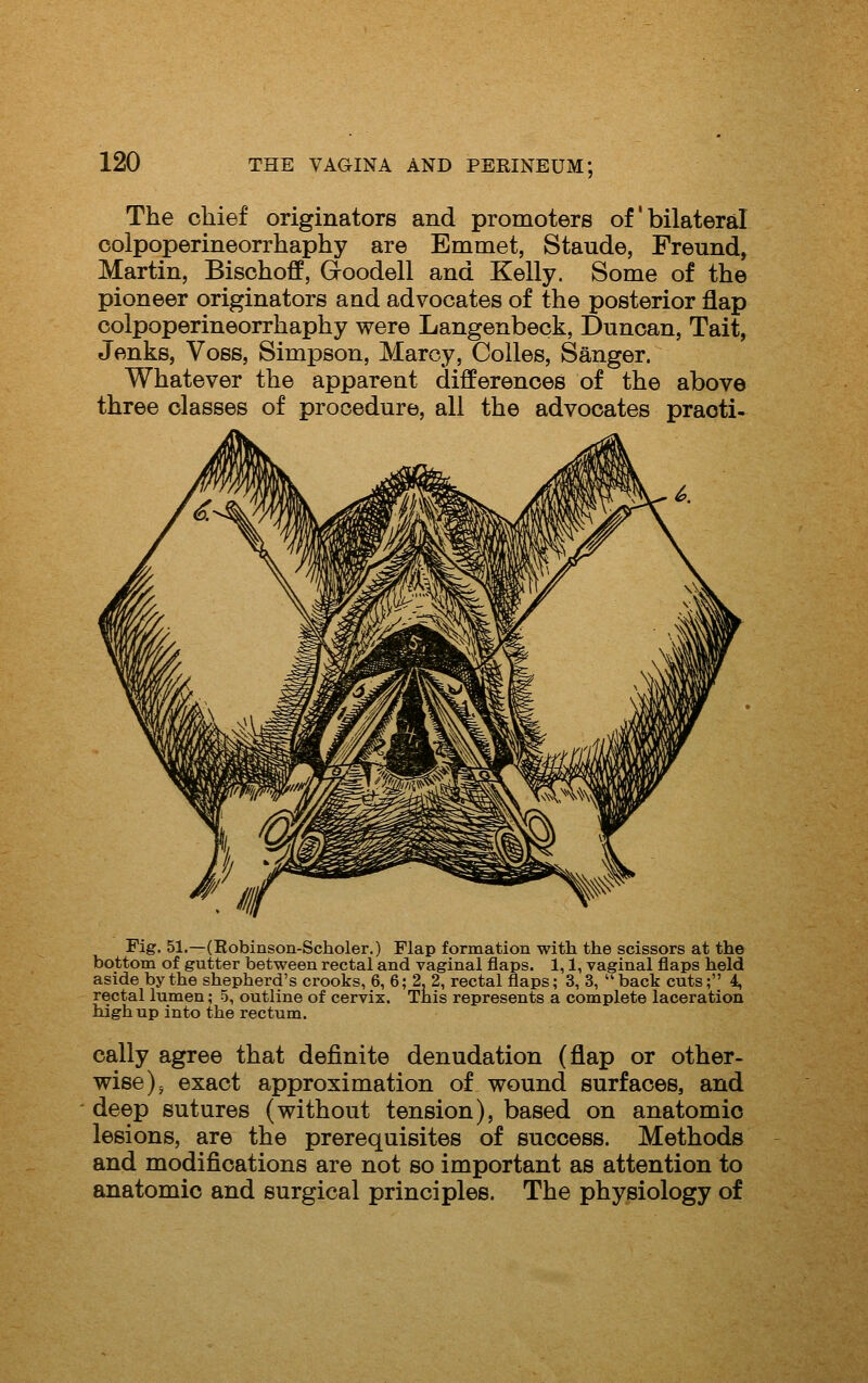 The chief originators and promoters of bilateral colpoperineorrhaphy are Emmet, Staude, Freund, Martin, Bischoff, Groodell and Kelly. Some of the pioneer originators and advocates of the posterior flap colpoperineorrhaphy were Langenbeck, Duncan, Tait, Jenks, Voss, Simpson, Marcy, Colles, Sanger. Whatever the apparent differences of the above three classes of procedure, all the advocates praoti- Fig. 51.—(Robinson-Scholer.) Flap formation with the scissors at the bottom of gutter between rectal and vaginal flaps. 1,1, vaginal flaps held aside by the shepherd's crooks, 6, 6; 2, 2, rectal flaps; 3, 3, back cuts; 4, rectal lumen; 5, outline of cervix. Tnis represents a complete laceration high up into the rectum. cally agree that definite denudation (flap or other- wise )5 exact approximation of wound surfaces, and deep sutures (without tension), based on anatomic lesions, are the prerequisites of success. Methods and modifications are not so important as attention to anatomic and surgical principles. The physiology of