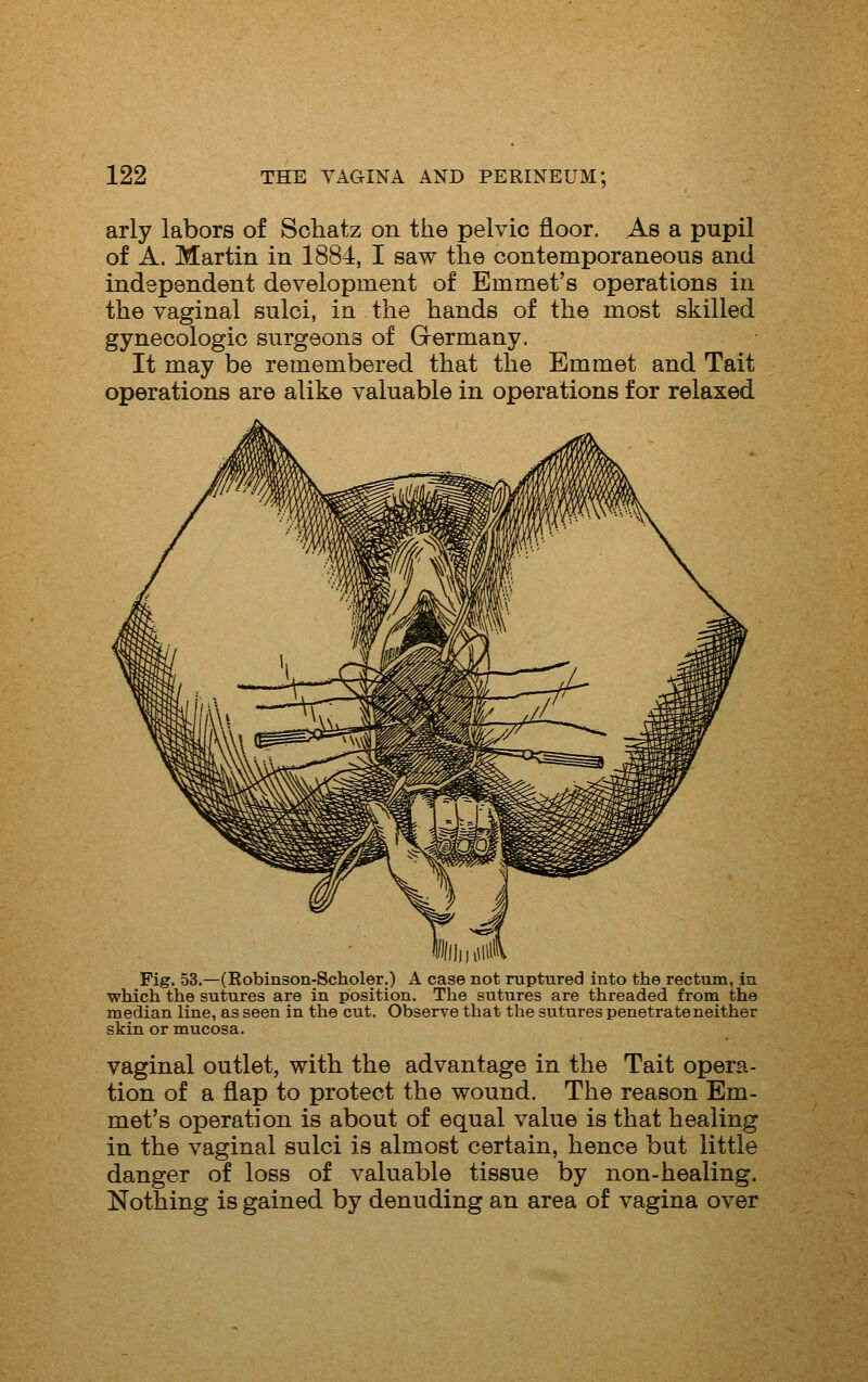 arly labors of Schatz on the pelvic floor. As a pupil of A. Martin in 1884, I saw the contemporaneous and independent development of Emmet's operations in the vaginal sulci, in the hands of the most skilled gynecologic surgeons of Germany. It may be remembered that the Emmet and Tait operations are alike valuable in operations for relaxed Fig. 53.—(Robinson-Scholer.) A case not ruptured into the rectum, in which the sutures are in position. The sutures are threaded from the median line, as seen in the cut. Observe that the sutures penetrate neither skin or mucosa. vaginal outlet, with the advantage in the Tait opera- tion of a flap to protect the wound. The reason Em- met's operation is about of equal value is that healing in the vaginal sulci is almost certain, hence but little danger of loss of valuable tissue by non-healing. Nothing is gained by denuding an area of vagina over