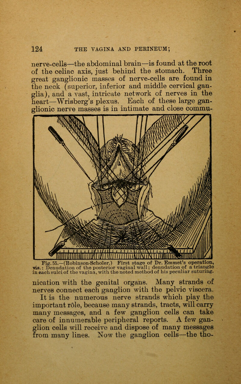 nerve-cells—the abdominal brain—is found at the root of the celiac axis, just behind the stomach. Three great ganglionic masses of nerve-cells are found in the neck (superior, inferior and middle cervical gan- glia), and a vast, intricate network of nerves in the heart—Wrisberg's plexus. Each of these large gan- glionic nerve masses is in intimate and close commu- Fig. 55.—(Robinson-Scholer.) First stage of Dr. Emmet's operation, ■via.: Denudation of the posterior vaginal wall; denudation of a triangle in each sulci of the vagina, with the noted method of his peculiar suturing. nication with the genital organs. Many strands of nerves connect each ganglion with the pelvic viscera. It is the numerous nerve strands which play the important role, because many strands, tracts, will carry many messages, and a few ganglion cells can take care of innumerable peripheral reports. A few gan- glion cells will receive and dispose of many messages from many lines. Now the ganglion cells—the tho-