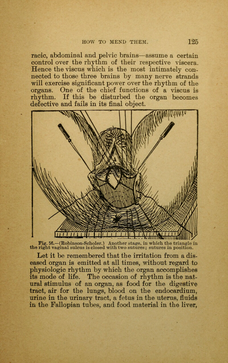 racic, abdomiDal and pelvic brains—assume a certain control over the rhythm of their respective viscera. Hence the viscus which is the most intimately con- nected to those three brains by many nerve strands will exercise significant power over the rhythm of the organs. One of the chief functions of a viscus is rhythm. If this be disturbed the organ becomes defective and fails in its final object. Pig. 56.—(Robinson-Scholer.) Another stage, in which the triangle in the right vaginal sulcus is closed with two sutures; sutures in position. Let it be remembered that the irritation from a dis- eased organ is emitted at all times, without regard to physiologic rhythm by which the organ accomplishes its mode of life. The occasion of rhythm is the nat- ural stimulus of an organ, as food for the digestive tract, air for the lungs, blood on the endocardium, urine in the urinary tract, a fetus in the uterus, fluids in the Fallopian tubes, and food material in the liver,