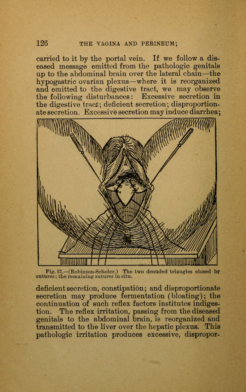 carried to it by the portal vein. If we follow a dis- eased message emitted from the pathologic genitals up to the abdominal brain over the lateral chain—the hypogastric ovarian plexus—where it is reorganized and emitted to the digestive tract, we may observe the following disturbances: Excessive secretion in the digestive traci; deficient secretion; disproportion- ate secretion. Excessive secretion may induce diarrhea; Fig. 57.—(Eobinson-Scholer.) The two denuded triangles closed by sutures; the remaining sutures in situ. deficient secretion, constipation; and disproportionate secretion may produce fermentation (bloating); the continuation of such reflex factors institutes indiges- tion. The reflex irritation, passing from the diseased genitals to the abdominal brain, is reorganized and transmitted to the liver over the hepatic plexus. This pathologic irritation produces excessive, dispropor-