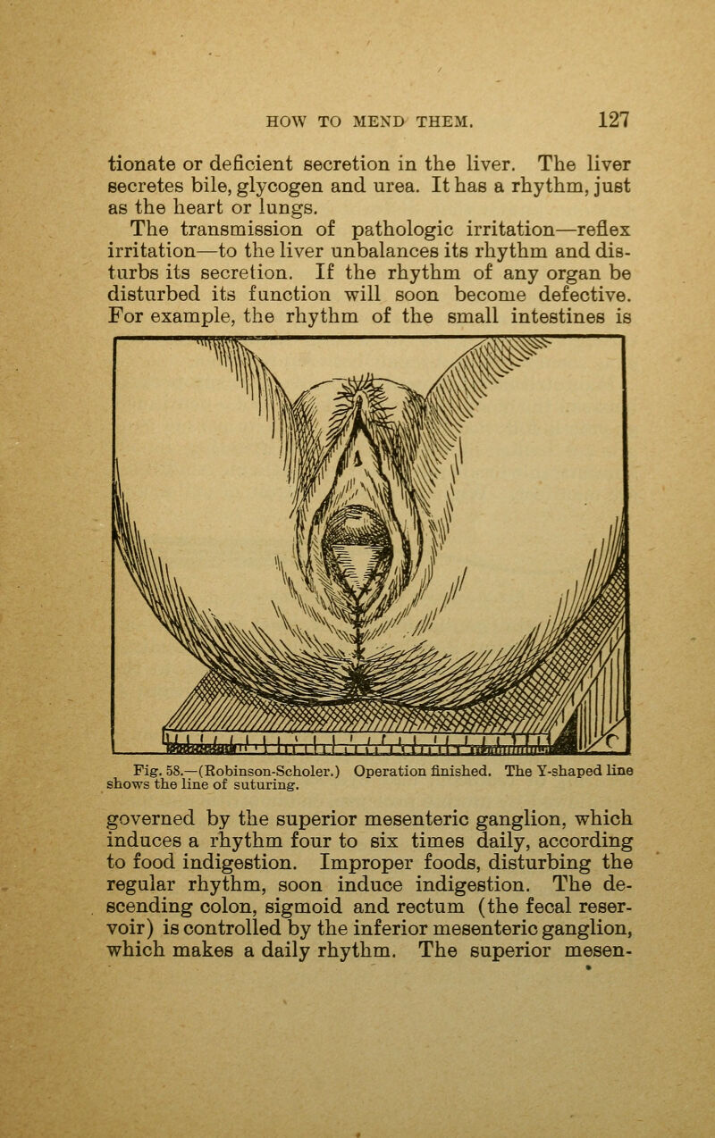 tionate or deficient secretion in the liver. The liver secretes bile, glycogen and urea. It has a rhythm, just as the heart or lungs. The transmission of pathologic irritation—reflex irritation—to the liver unbalances its rhythm and dis- turbs its secretion. If the rhythm of any organ be disturbed its function will soon become defective. For example, the rhythm of the small intestines is Fig. 58.—(Robinson-Scholer.) Operation finished. The Y-shaped line shows the line of suturing. governed by the superior mesenteric ganglion, which induces a rhythm four to six times daily, according to food indigestion. Improper foods, disturbing the regular rhythm, soon induce indigestion. The de- scending colon, sigmoid and rectum (the fecal reser- voir) is controlled by the inferior mesenteric ganglion, which makes a daily rhythm. The superior mesen-